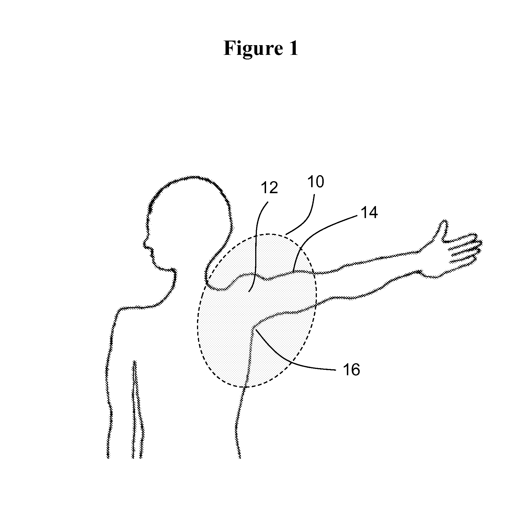 Methods and materials for reducing the risk of infections