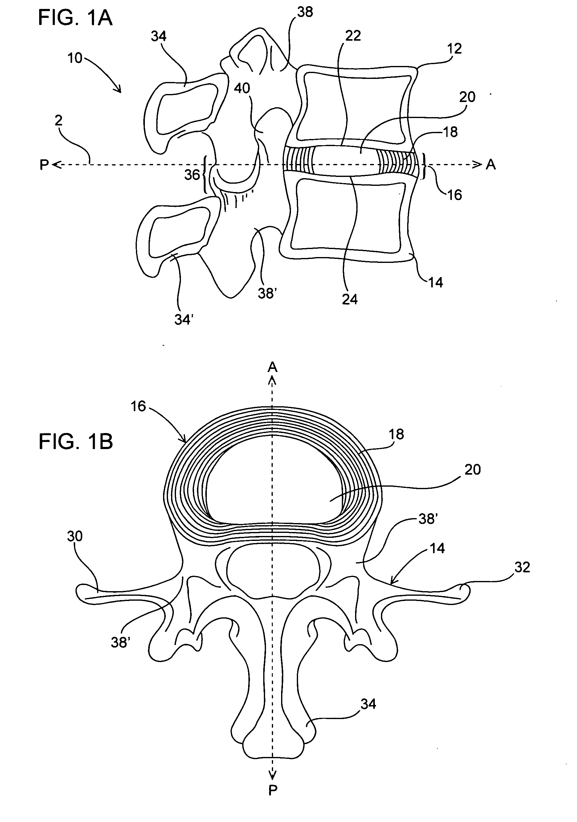 Devices, systems and methods for augmenting intervertebral discs