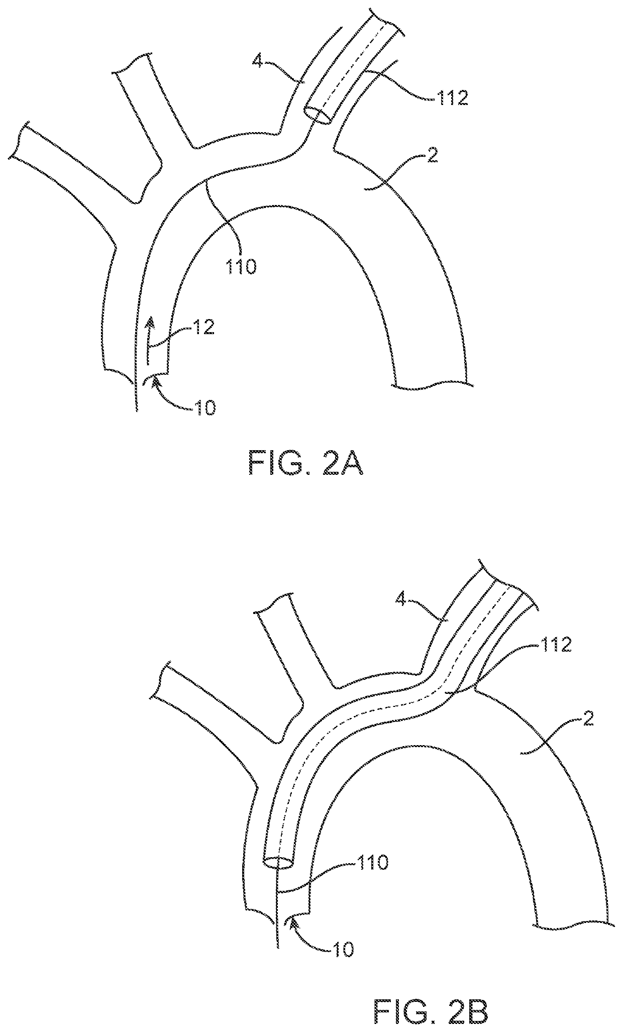 Accessory device to provide neuroprotection during interventional procedures