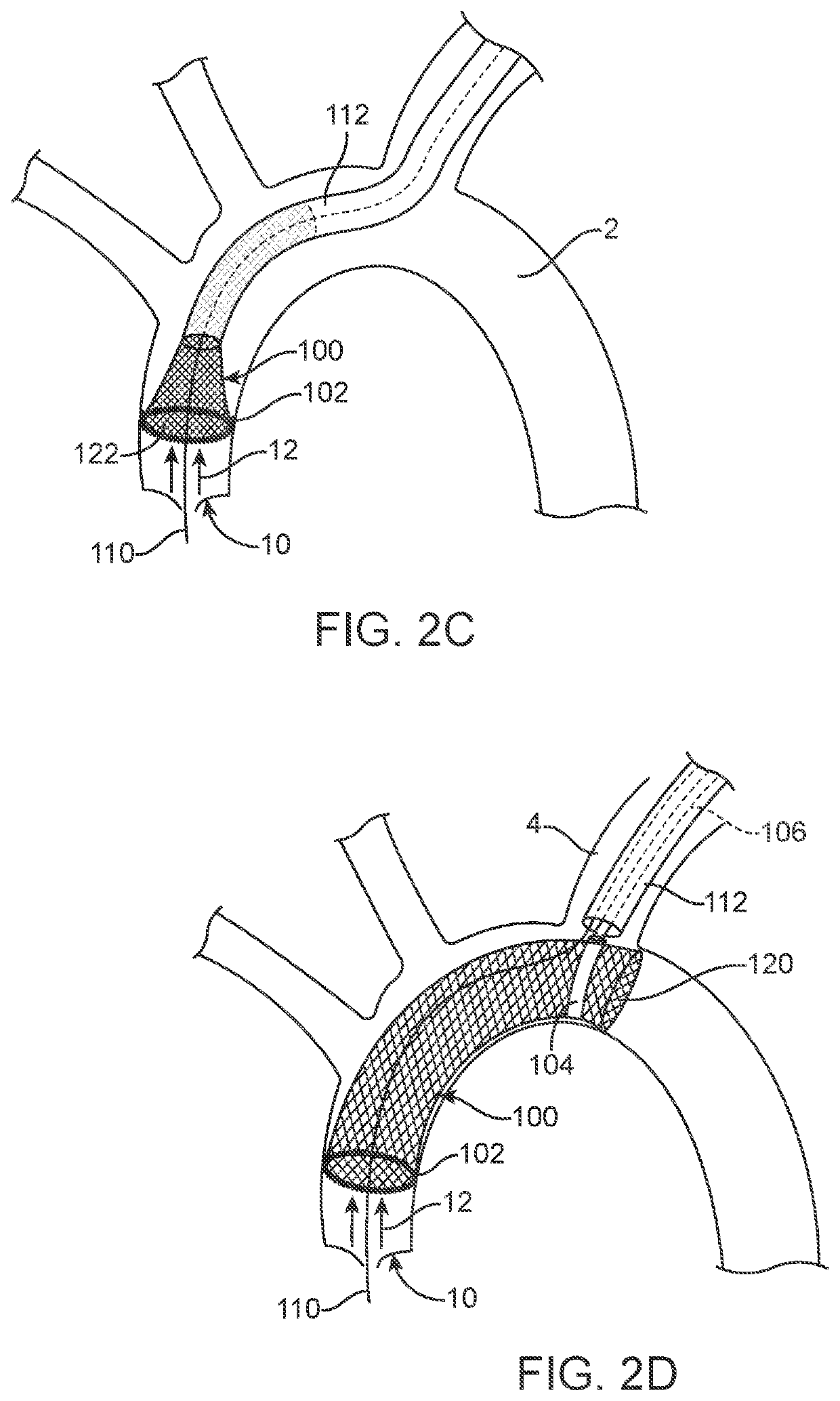 Accessory device to provide neuroprotection during interventional procedures