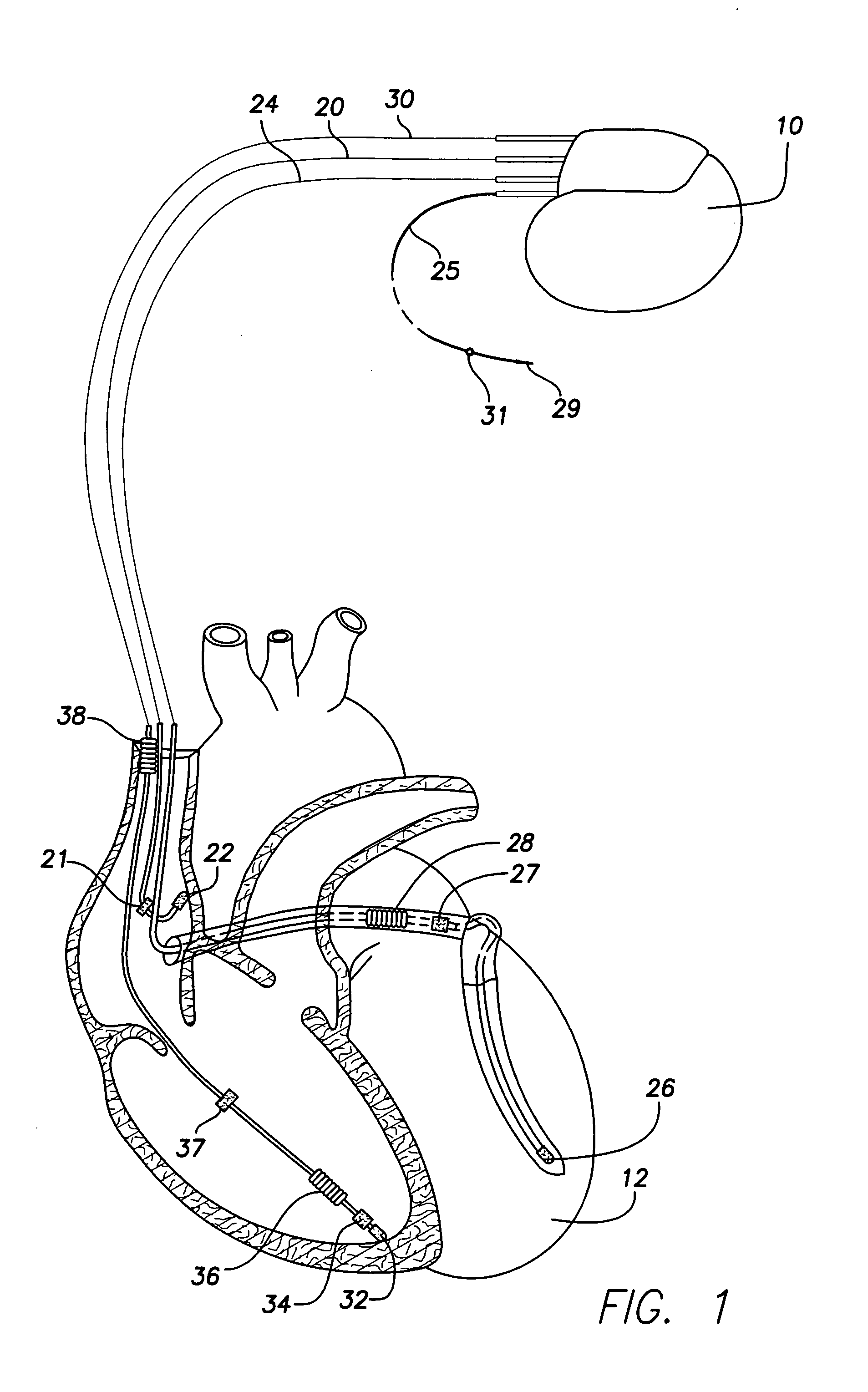 Implantable cardiac device with selectable tiered sleep apnea therapies and method