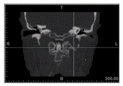 A navigation template and navigation puncture method for glossopharyngeal nerve navigation puncture