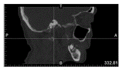 A navigation template and navigation puncture method for glossopharyngeal nerve navigation puncture