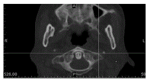 A navigation template and navigation puncture method for glossopharyngeal nerve navigation puncture