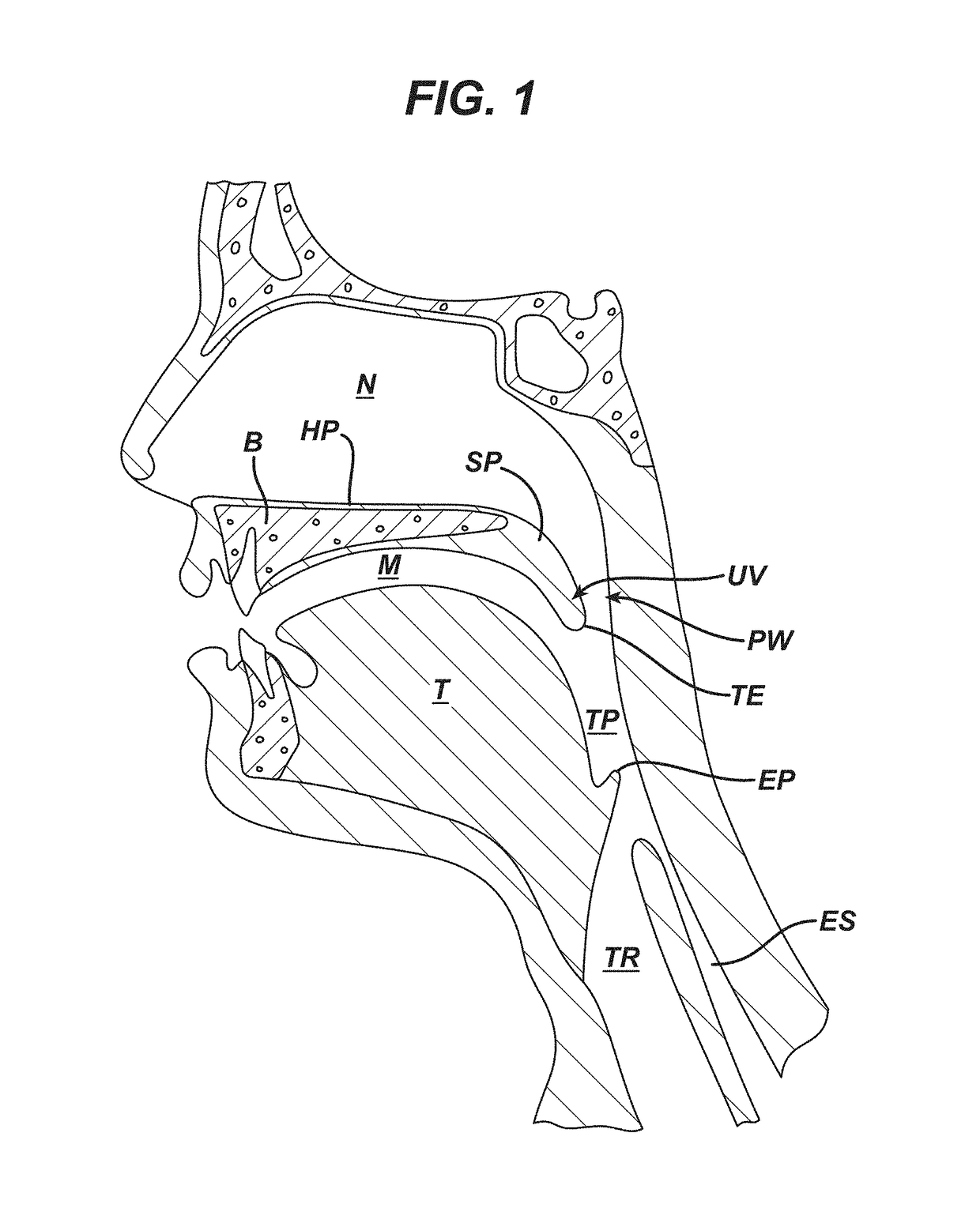 Method and device for treating obstructive sleep apnea