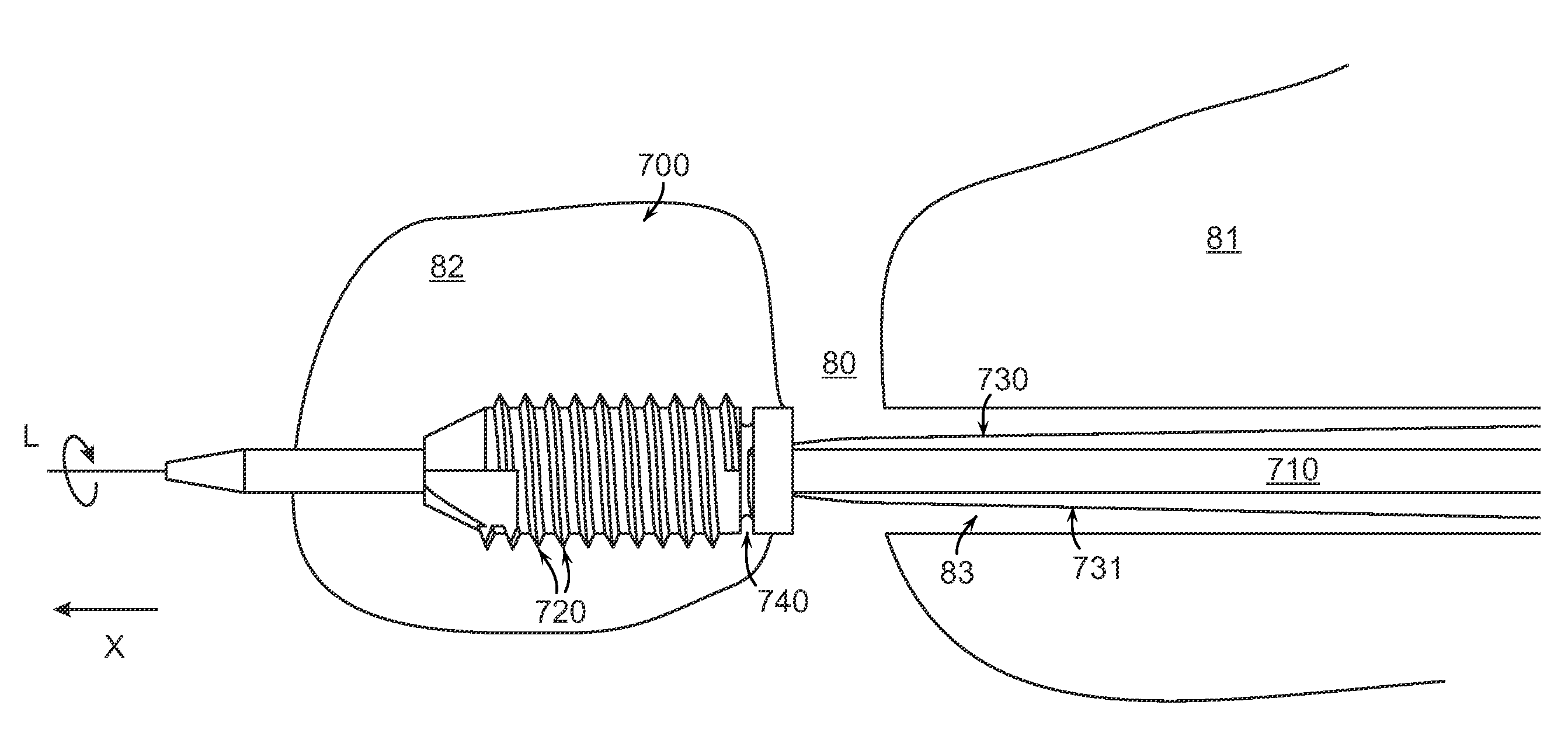 Cannulated anchor and system