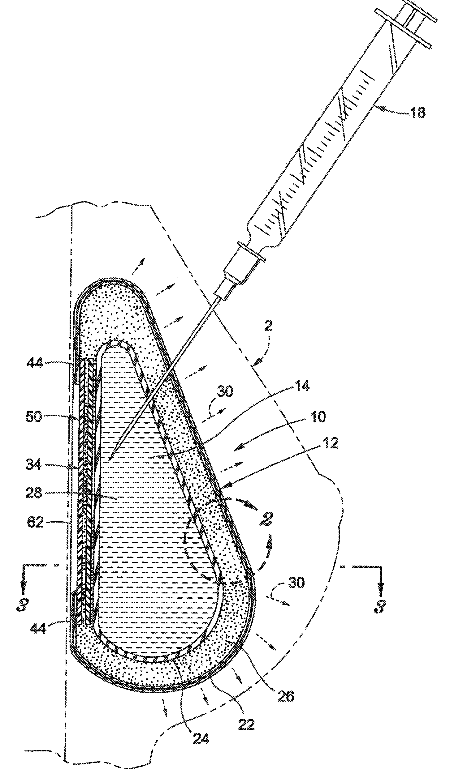 Inflatable prostheses and methods of making same