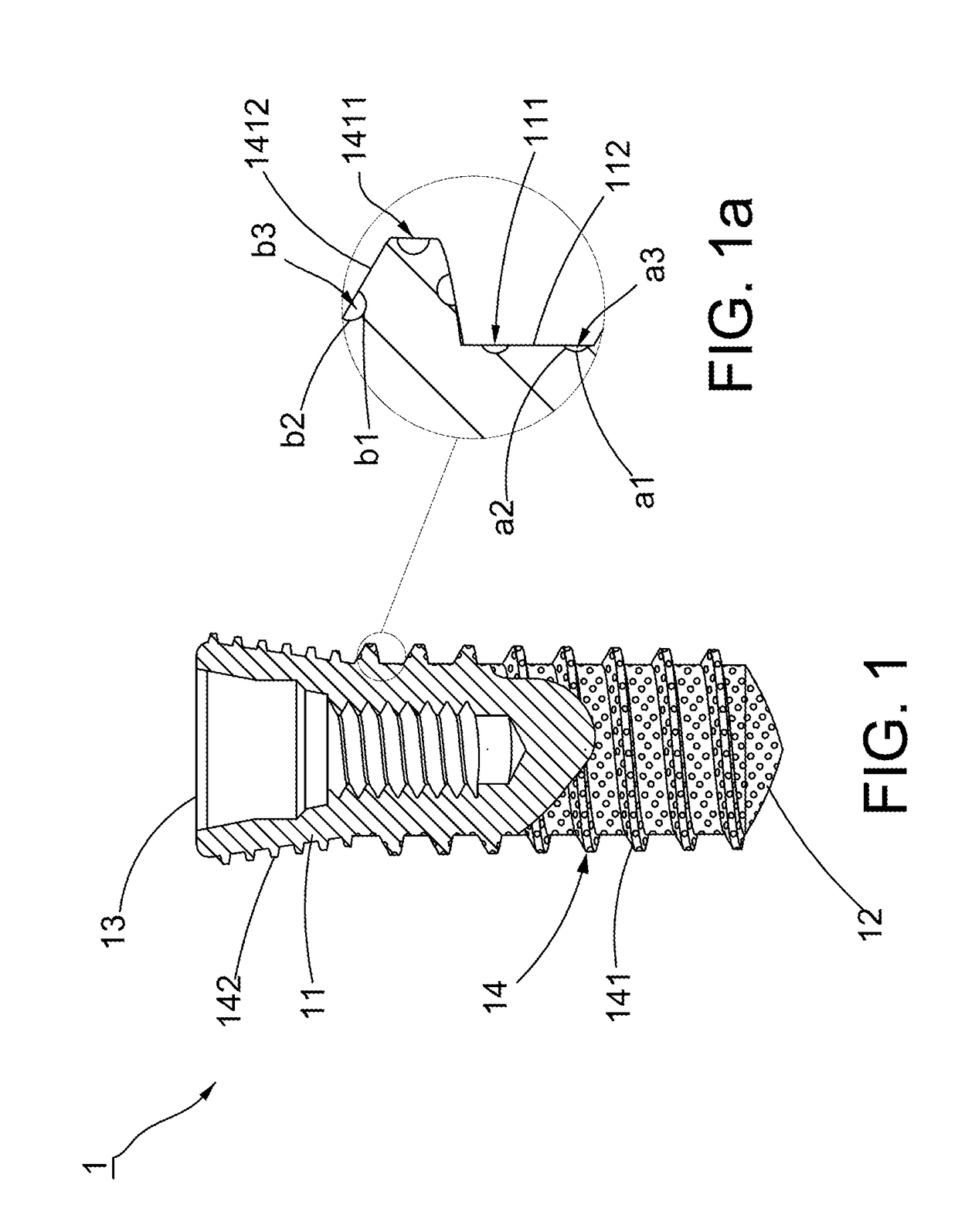 Root implant