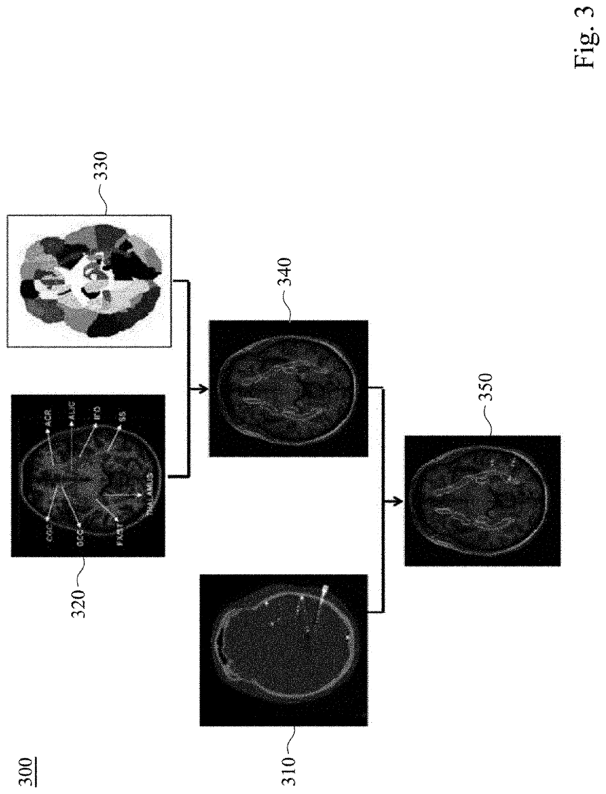 Method and system for localizing implanted intracranial electrode