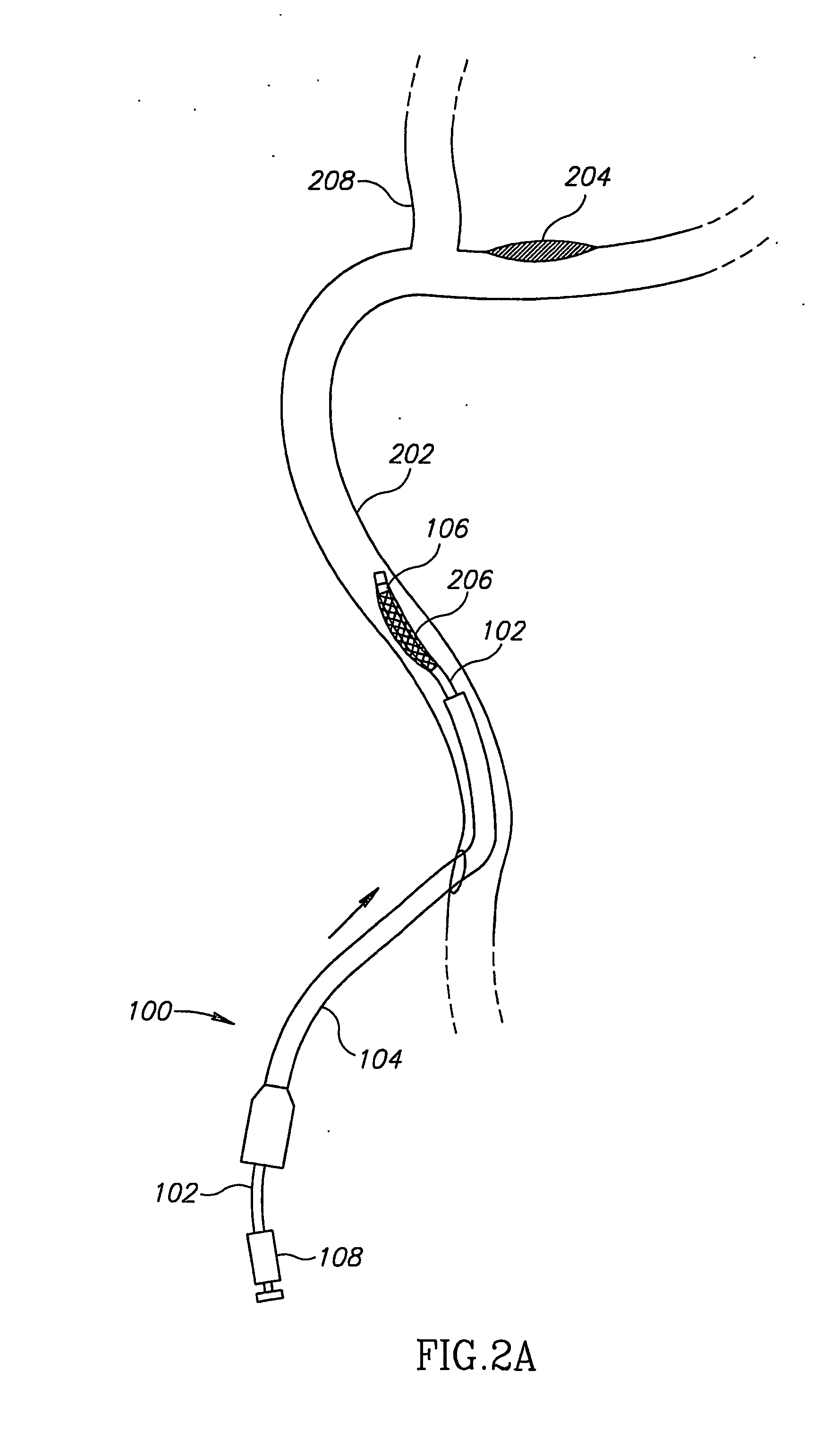 Stent Positioning Using Inflation Tube