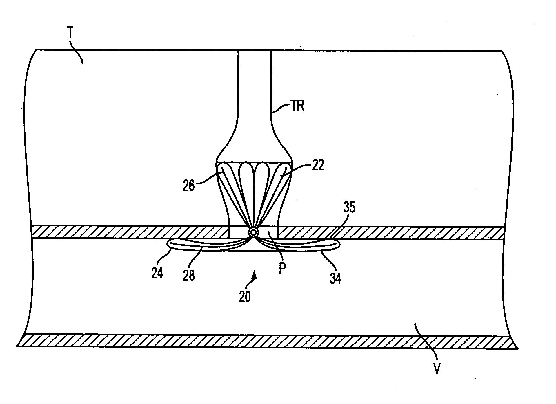 Apparatus for sealing surgical punctures