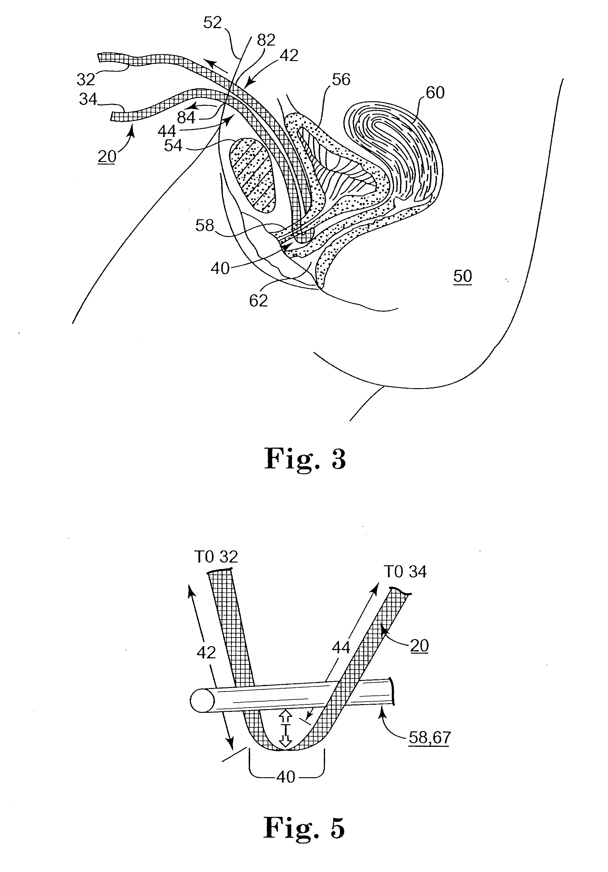 Adjustable Sling and Method of Treating Pelvic Conditions