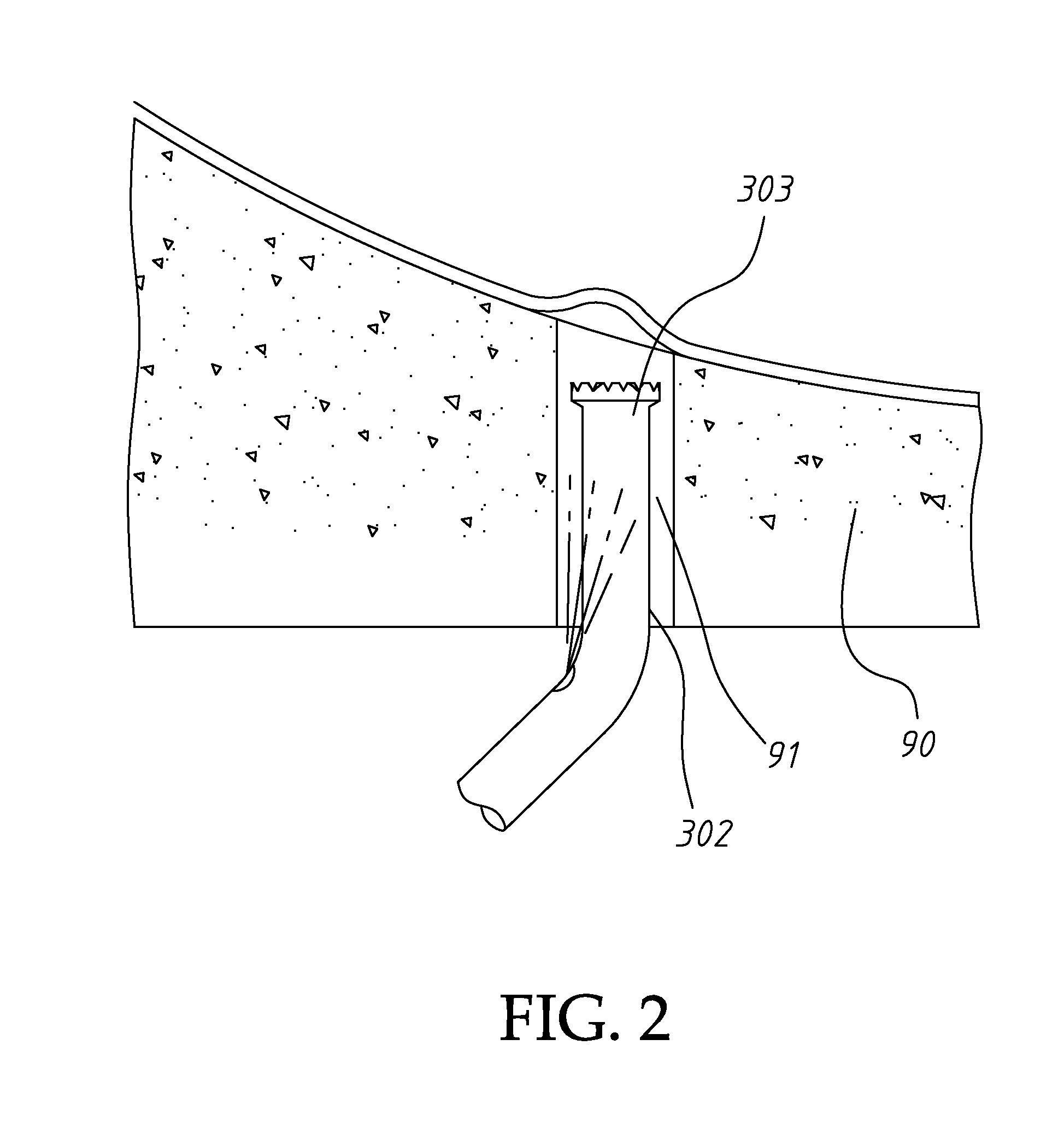 Ultrasonic dental implant tool set