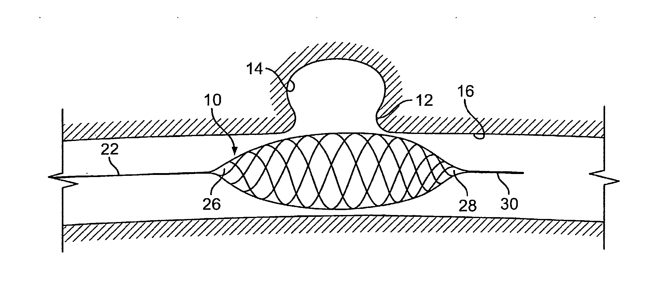 Aneurysm buttress arrangement