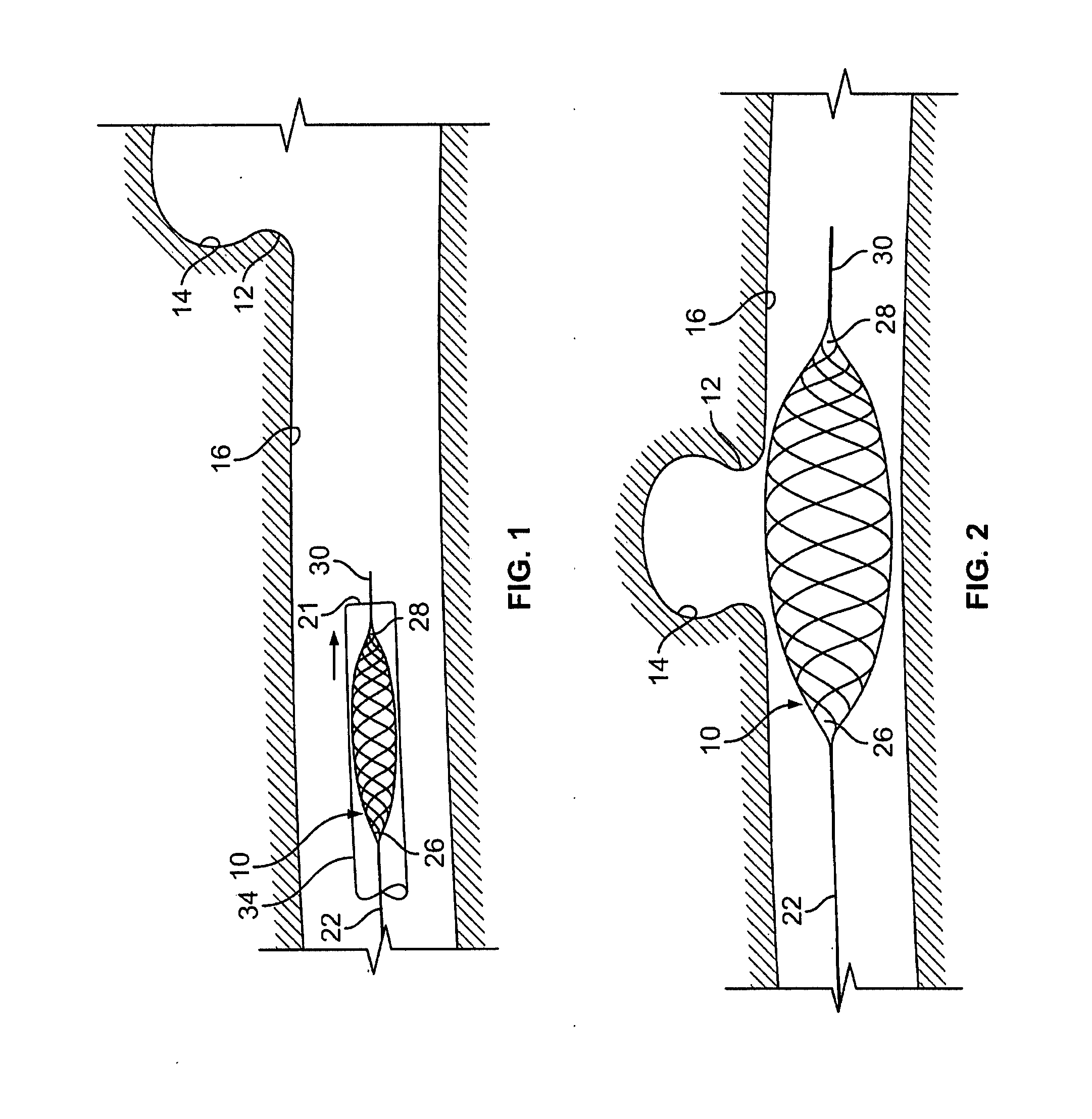 Aneurysm buttress arrangement