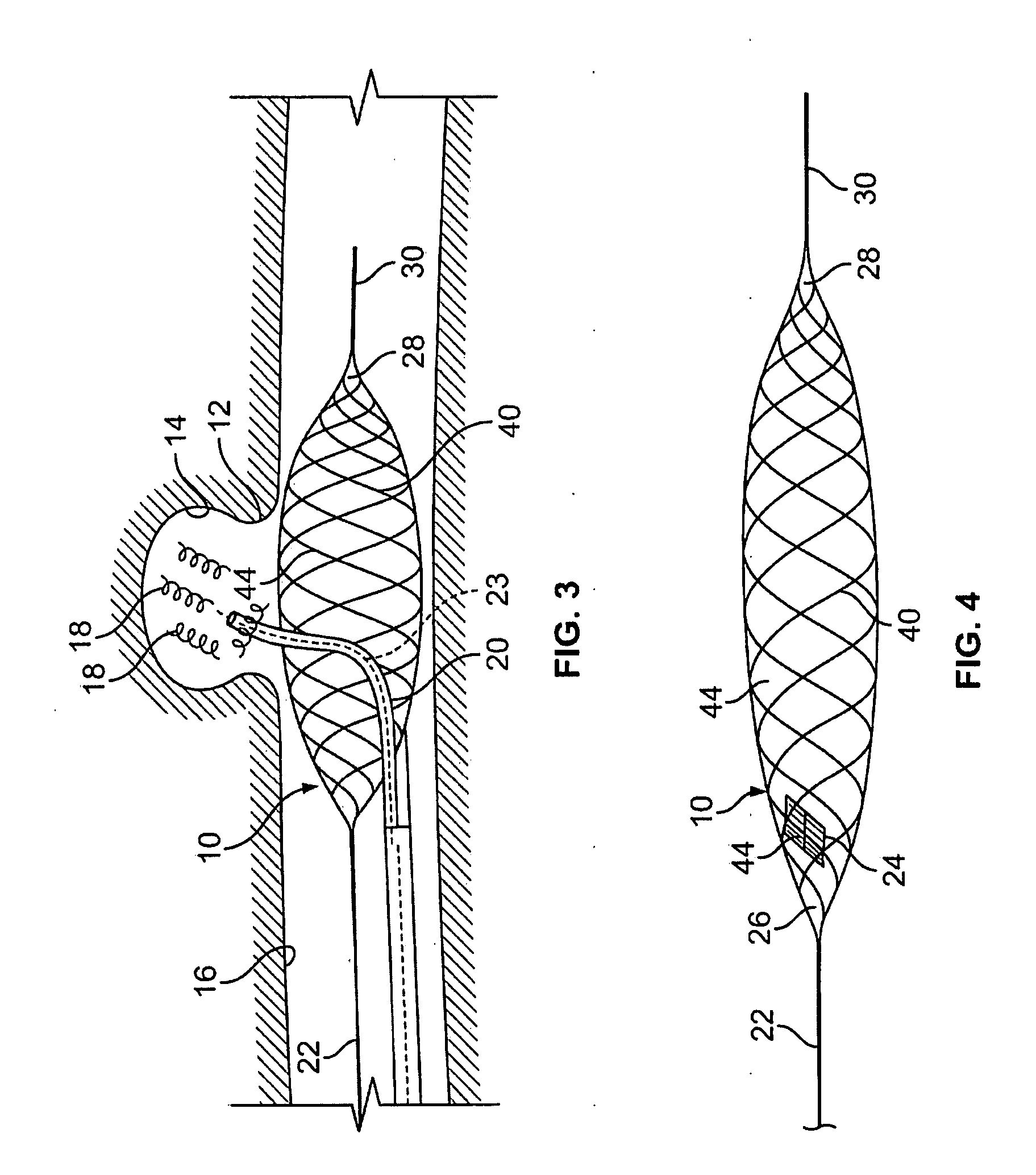 Aneurysm buttress arrangement