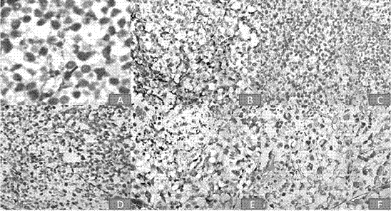 Traditional Chinese medicine composition for inhibiting vasculogenic mimicry and angiogenesis of intestinal cancer and application thereof