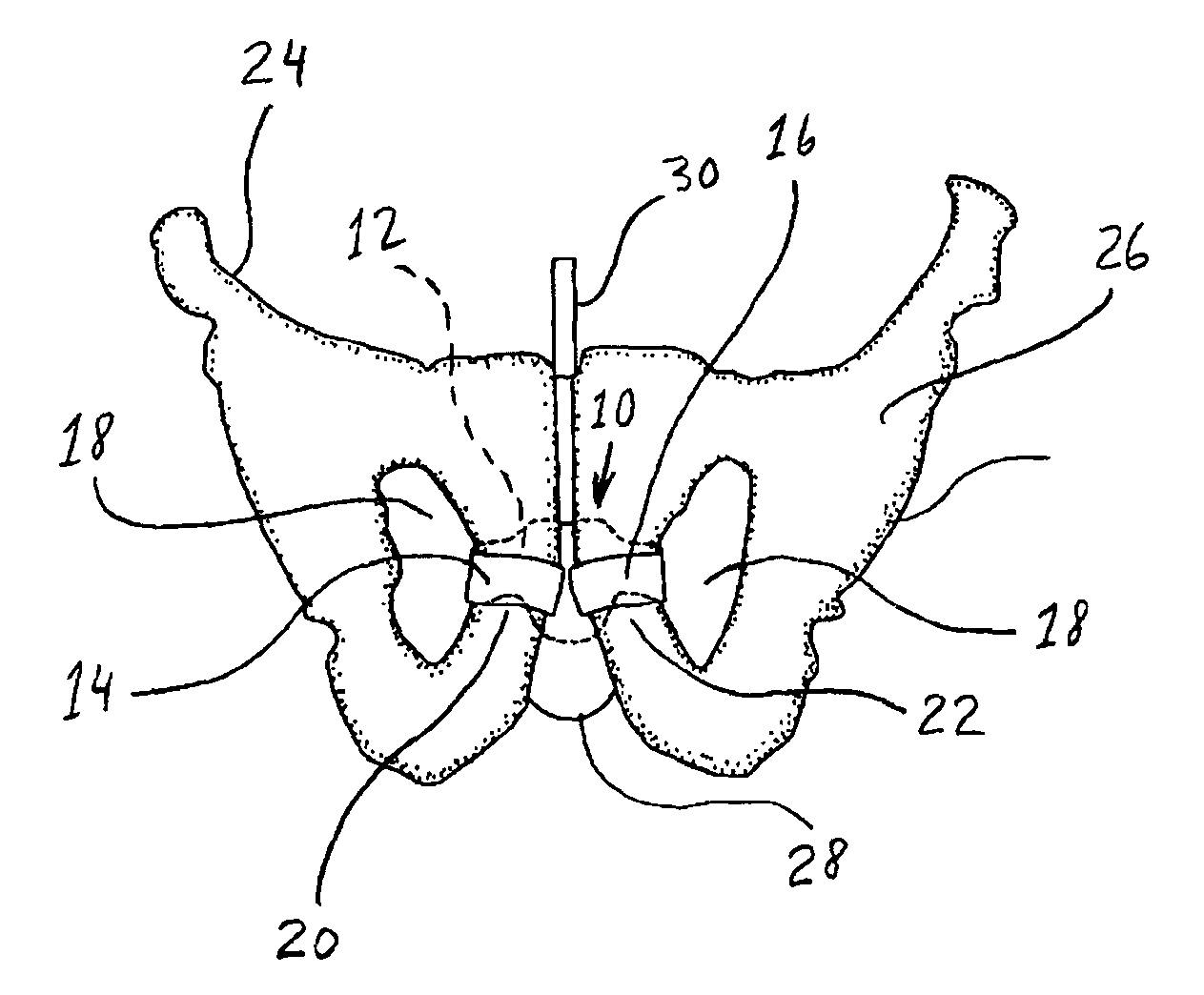 Implantable Sling For The Treatment Of Male Incontinence And Method Of Using The Same