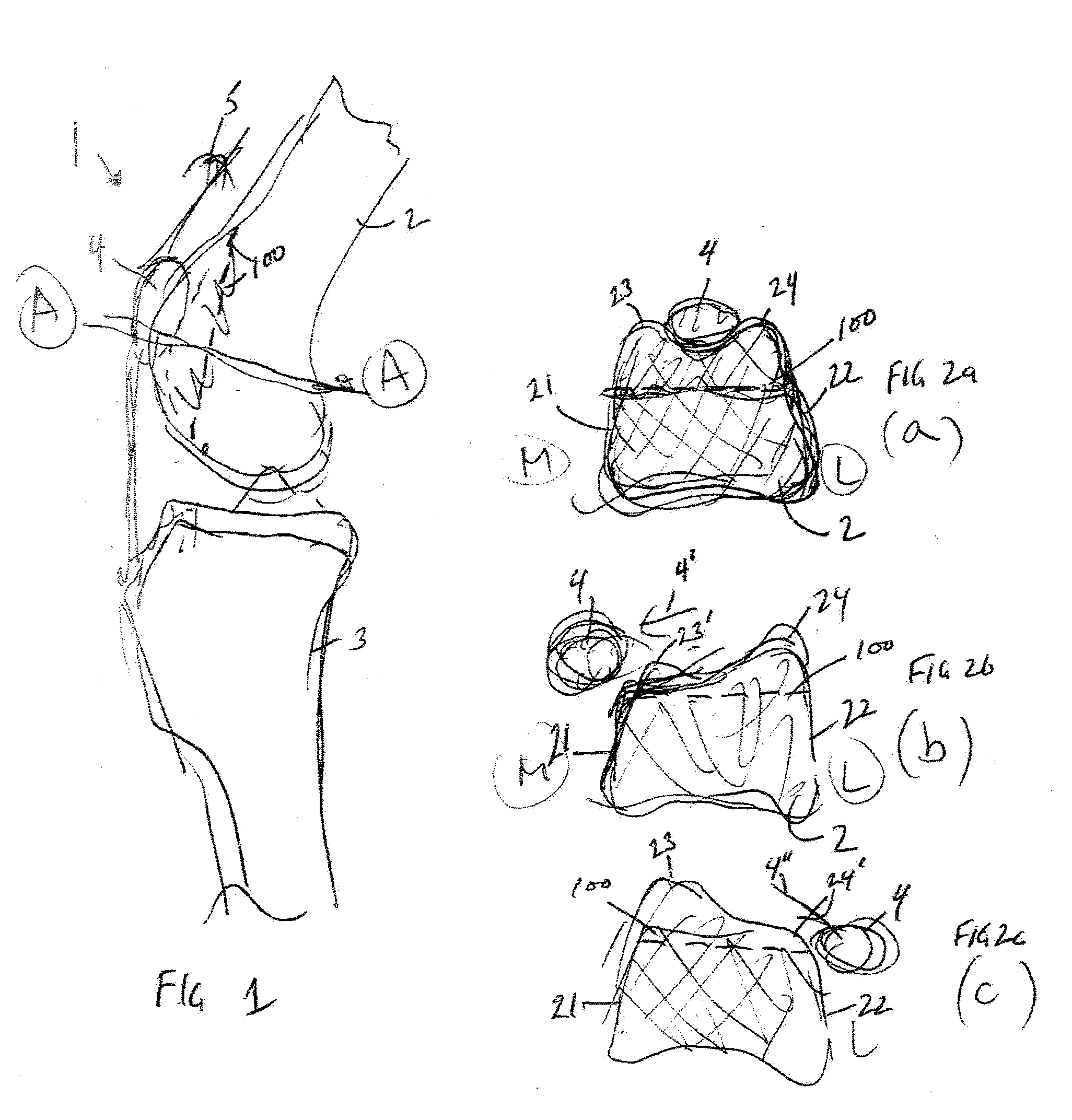 Trochlear groove prosthesis