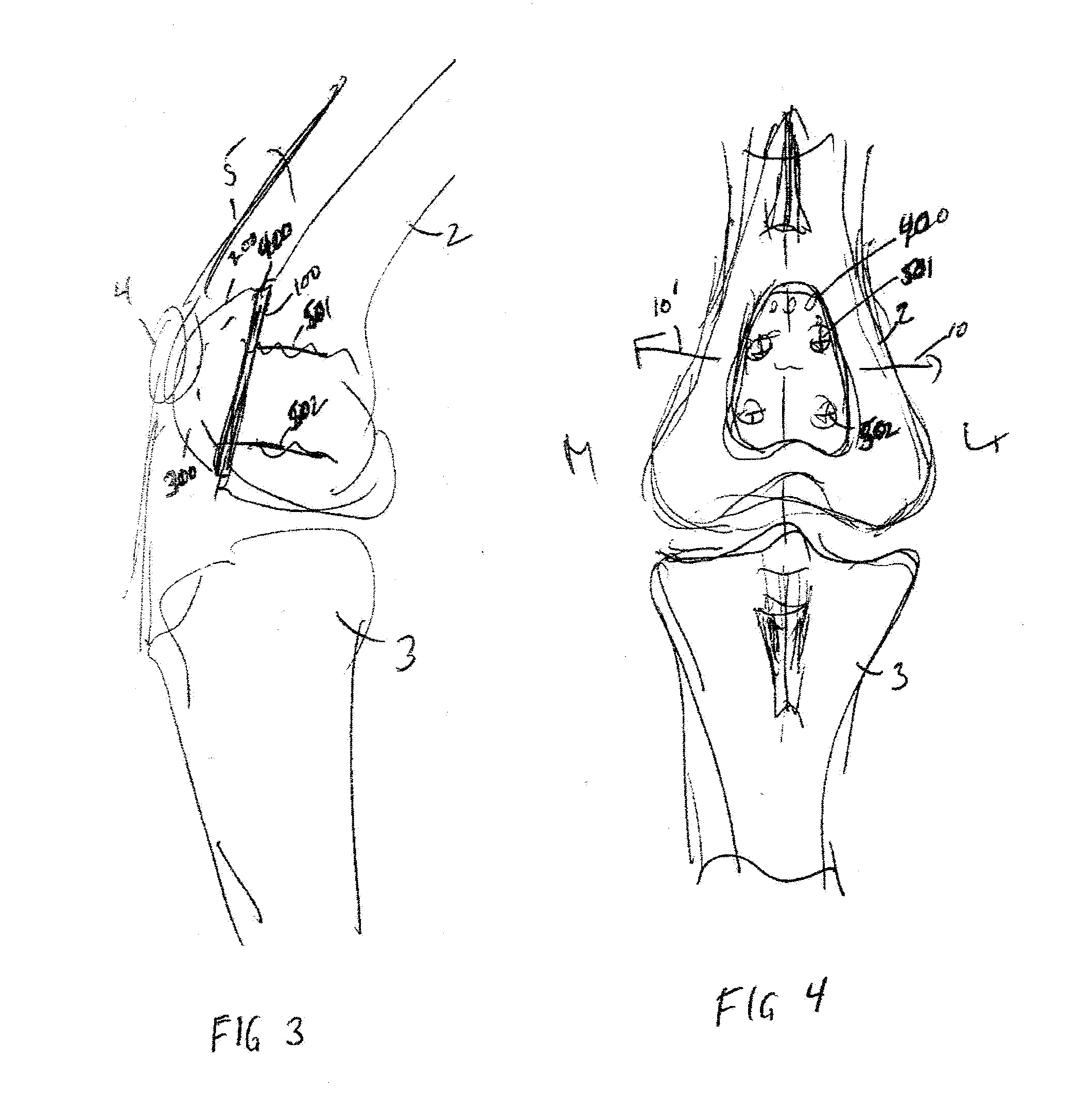 Trochlear groove prosthesis