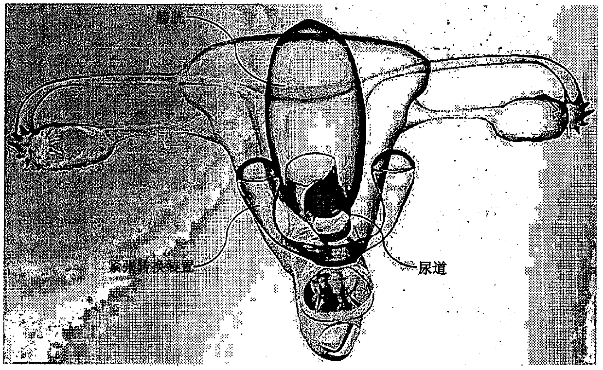 Infra-obturator tension transfer device