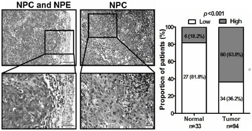 Application of reagents for detecting the expression level of long-chain non-coding RNA PVT1 in the preparation of diagnostic reagents for nasopharyngeal carcinoma