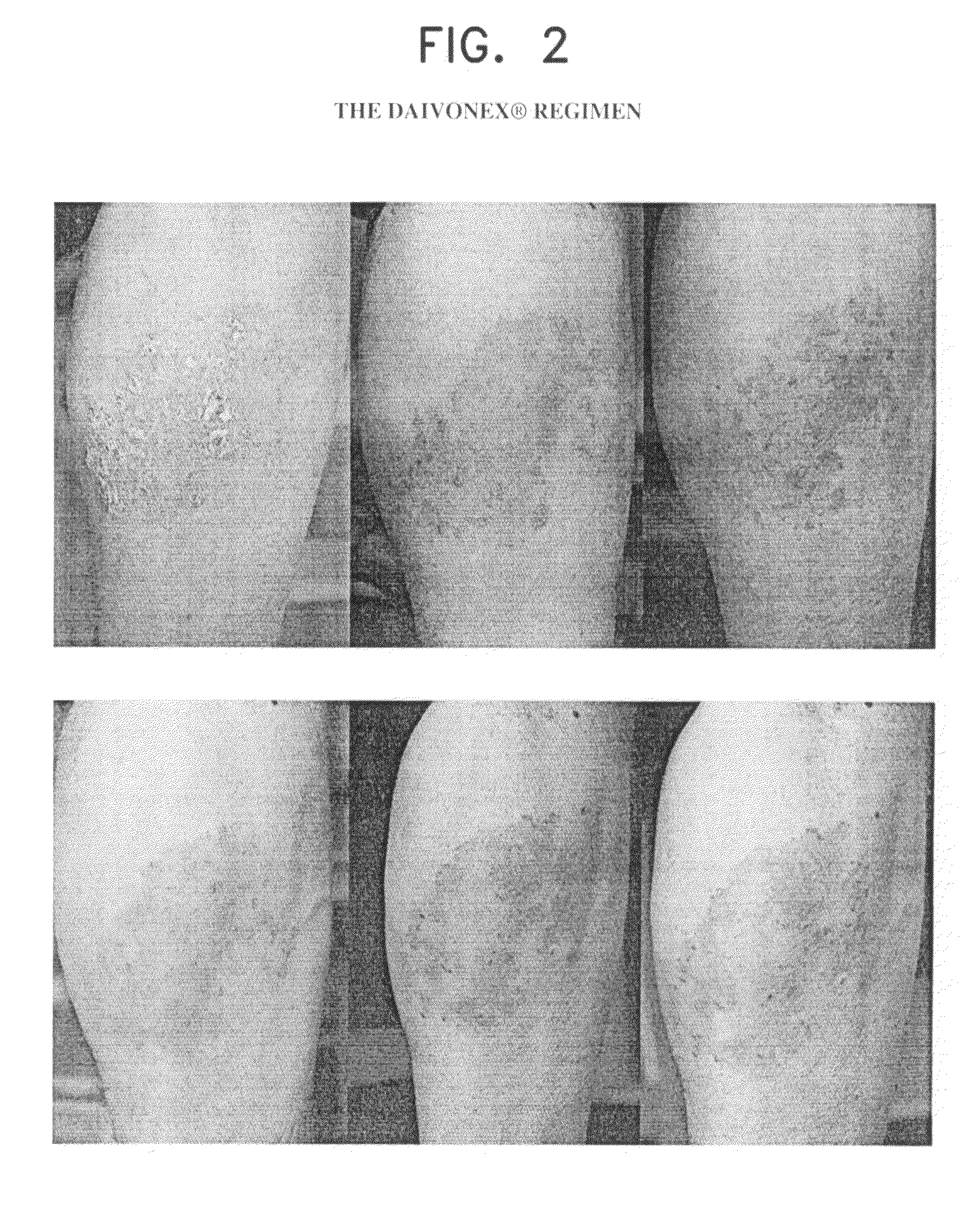 Novel pharmaceutical composition for topical treatment of skin psoriasis and the treatment method thereof