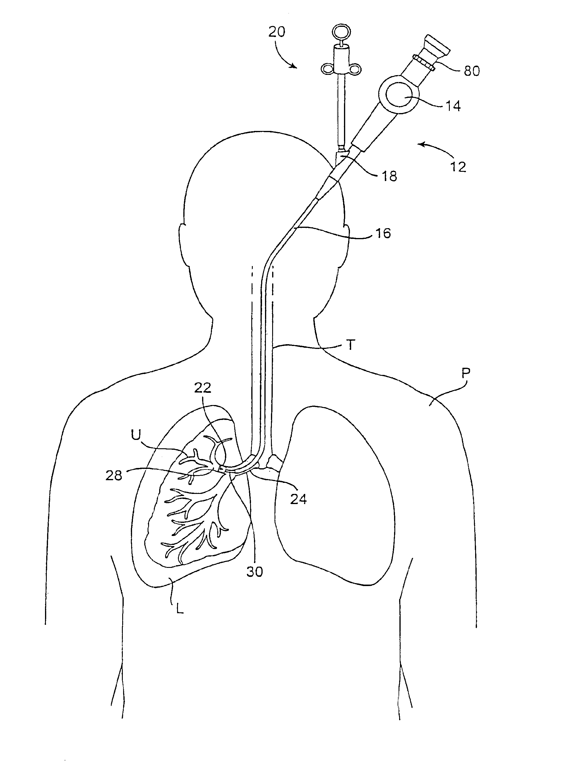 Methods and devices for use in performing pulmonary procedures