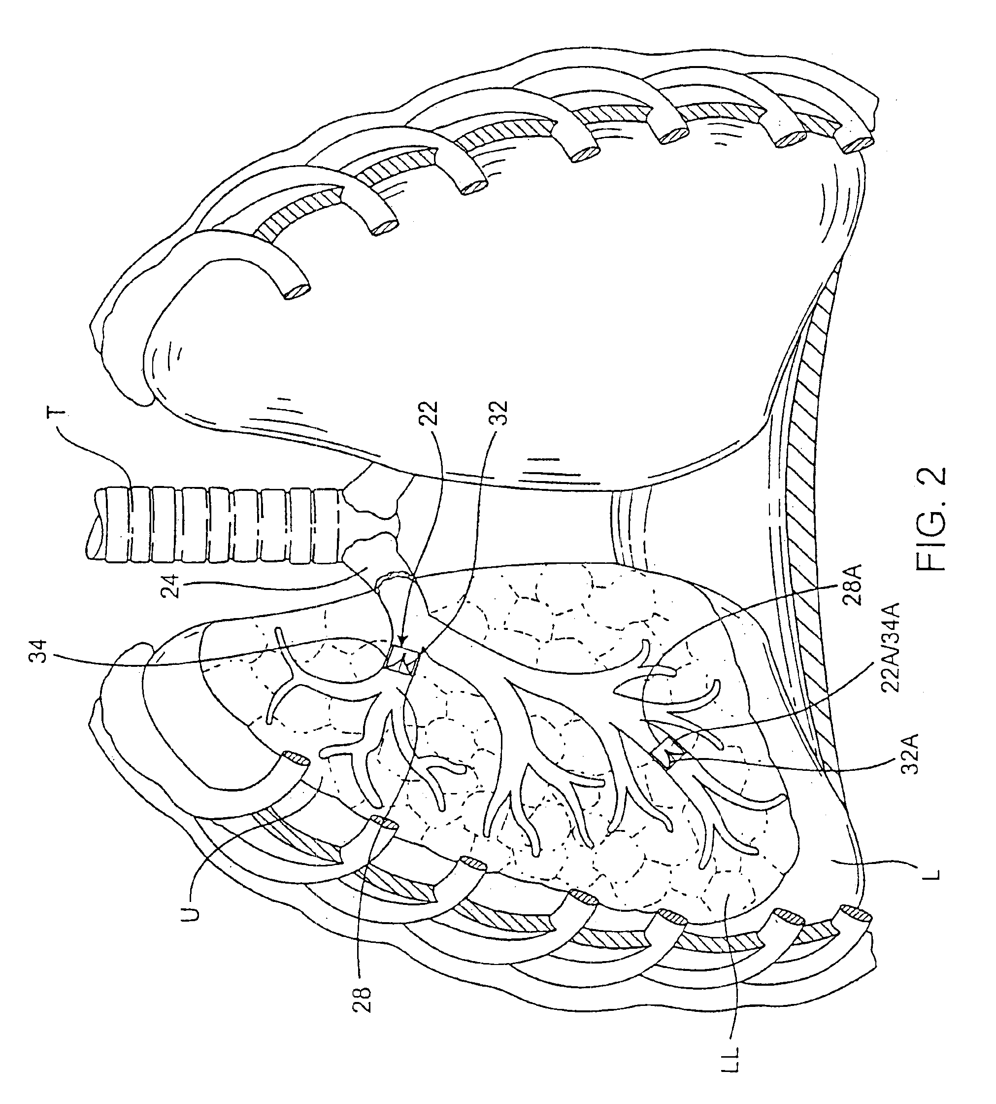 Methods and devices for use in performing pulmonary procedures