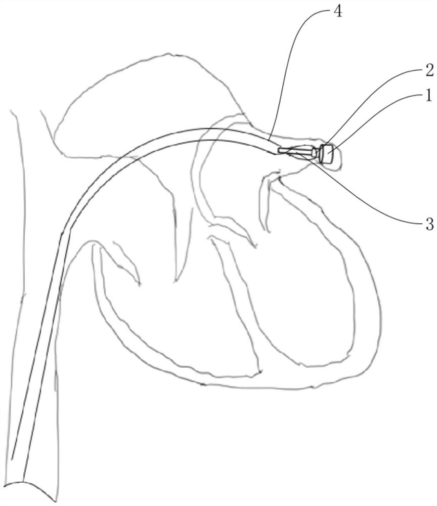 Left auricle plugging device