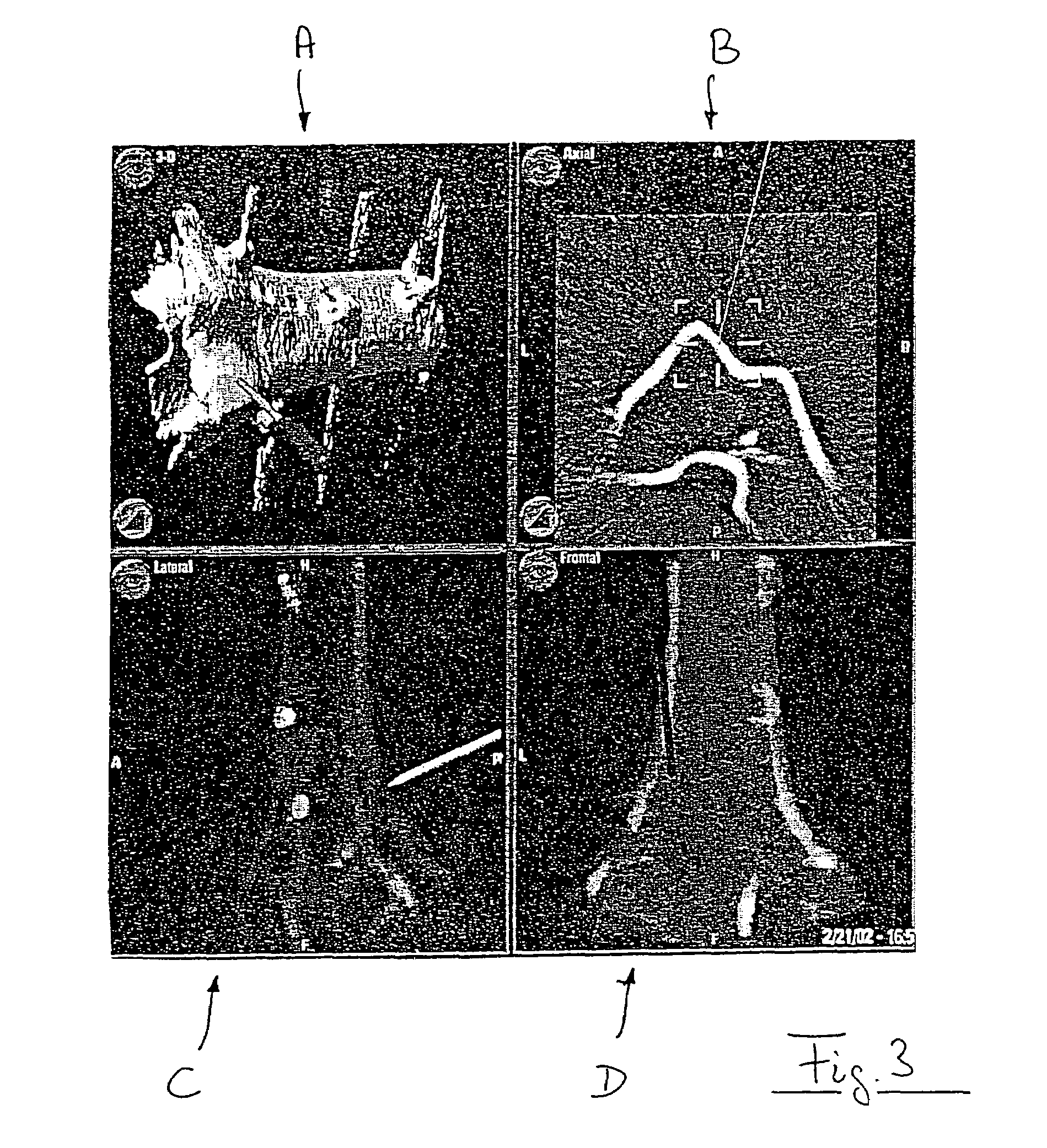 X-ray image-assisted navigation using original, two-dimensional x-ray images