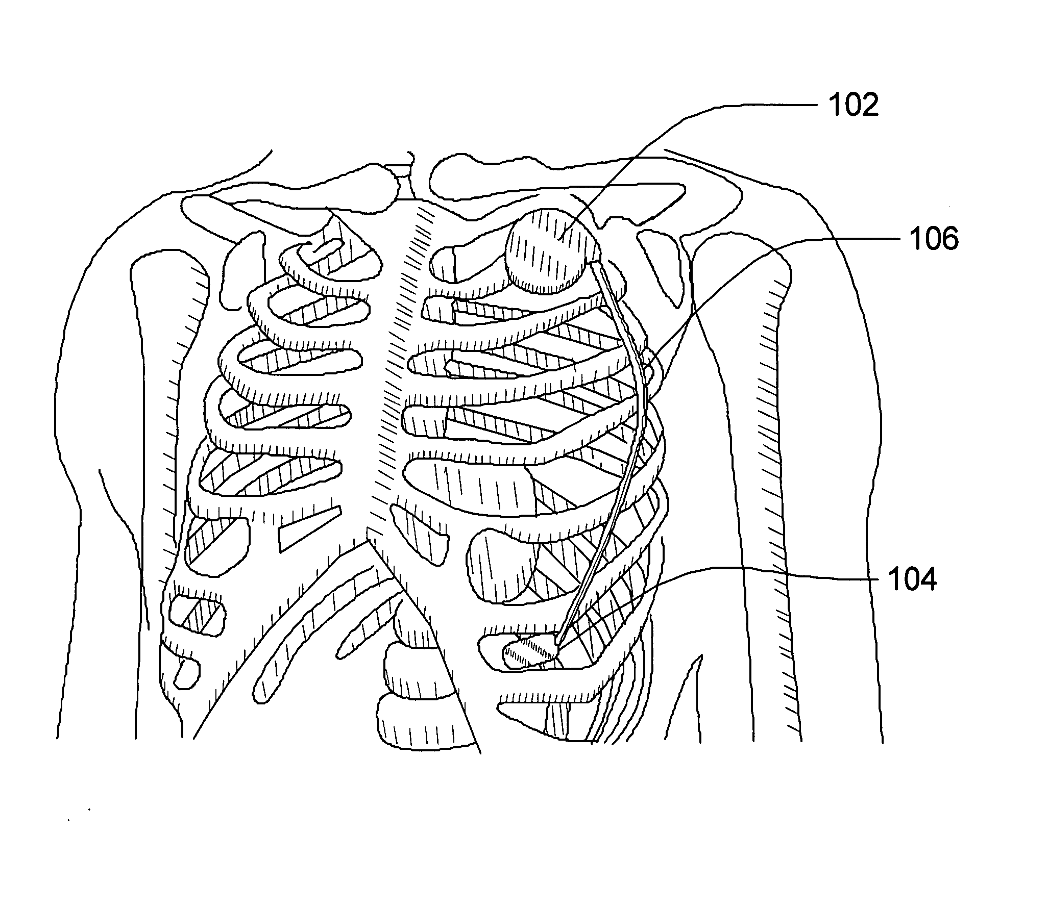 Subcutaneous cardiac sensing and stimulation system employing blood sensor