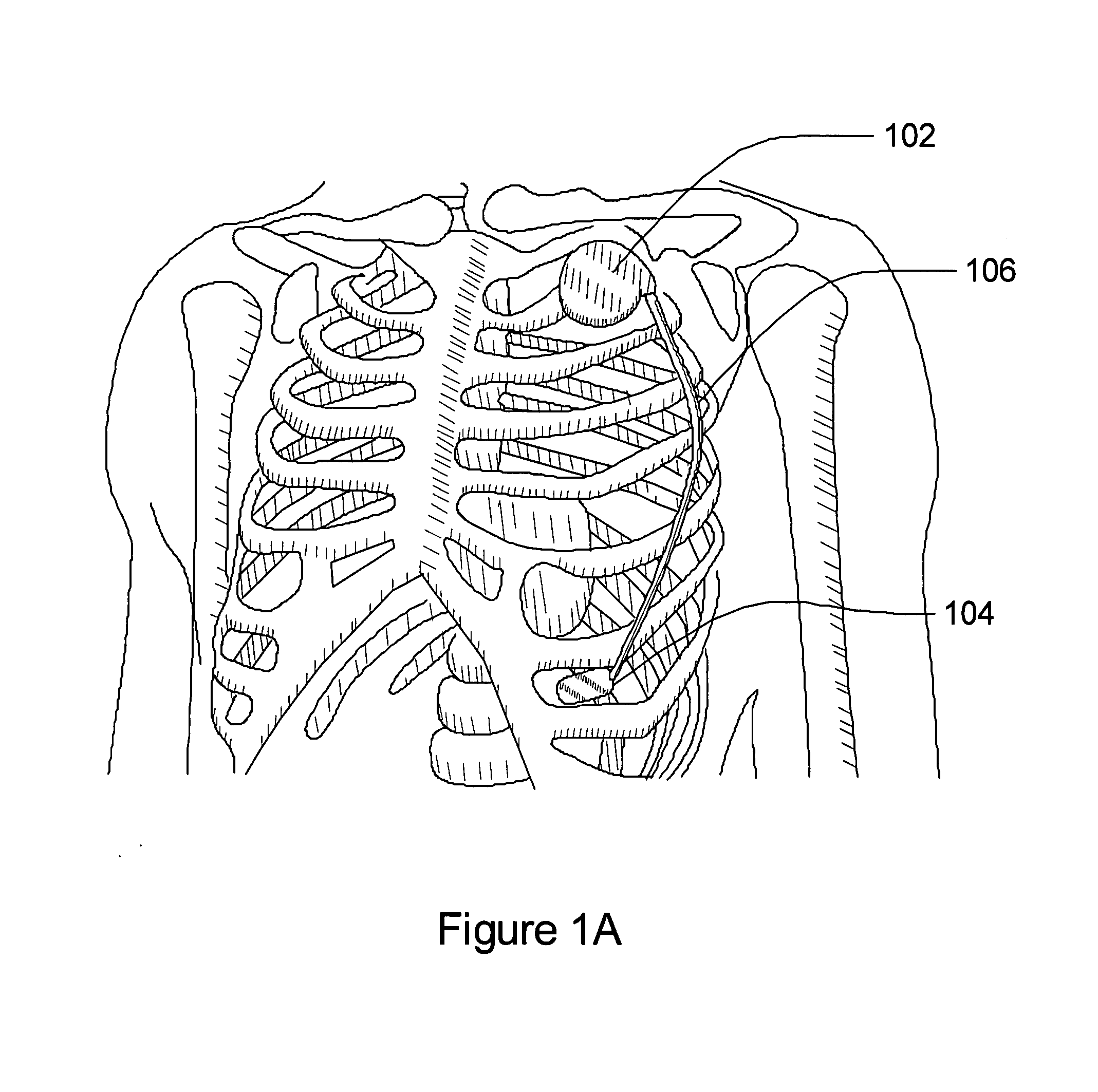 Subcutaneous cardiac sensing and stimulation system employing blood sensor