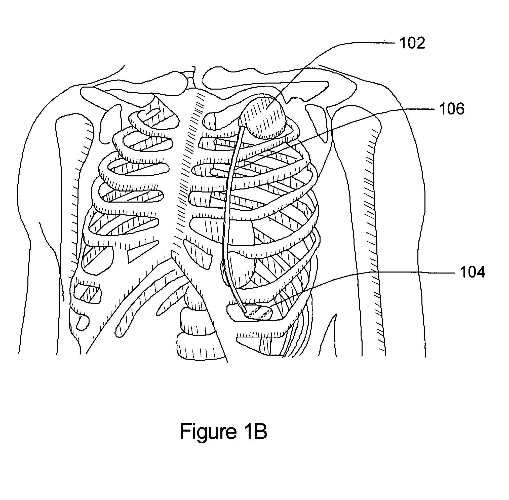 Subcutaneous cardiac sensing and stimulation system employing blood sensor