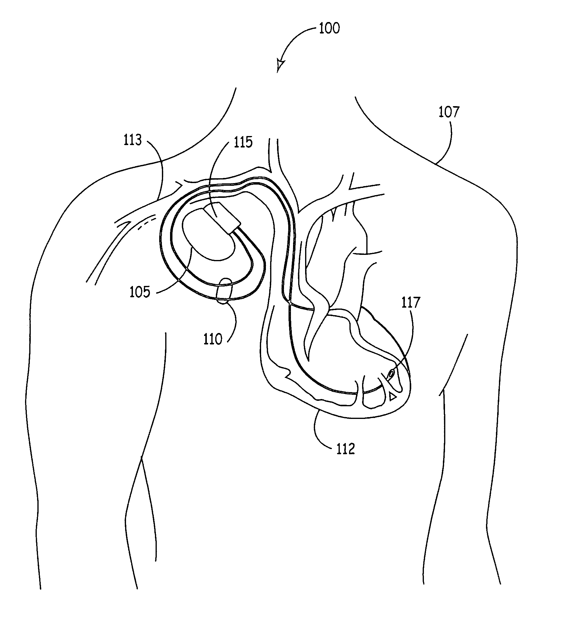 Methods and apparatus for reducing spurious signals in implantable medical devices caused by x-ray radiation