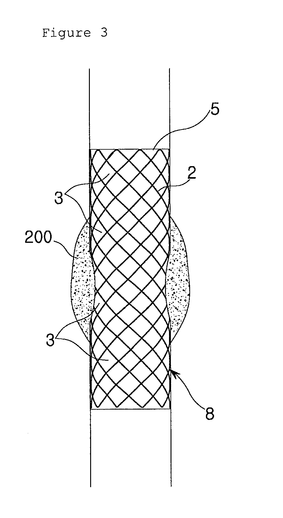 Wavily deformable stent and method for producing the same