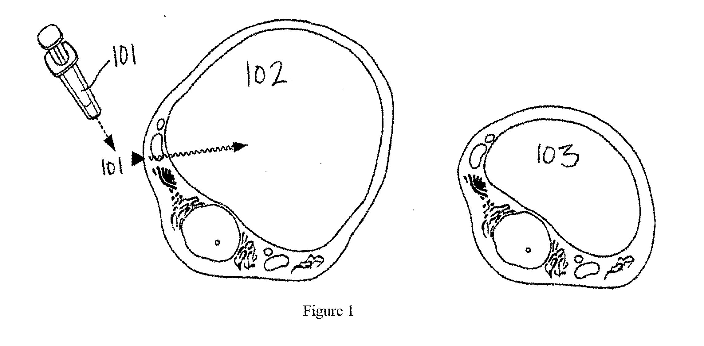 Method of treatment for body contouring