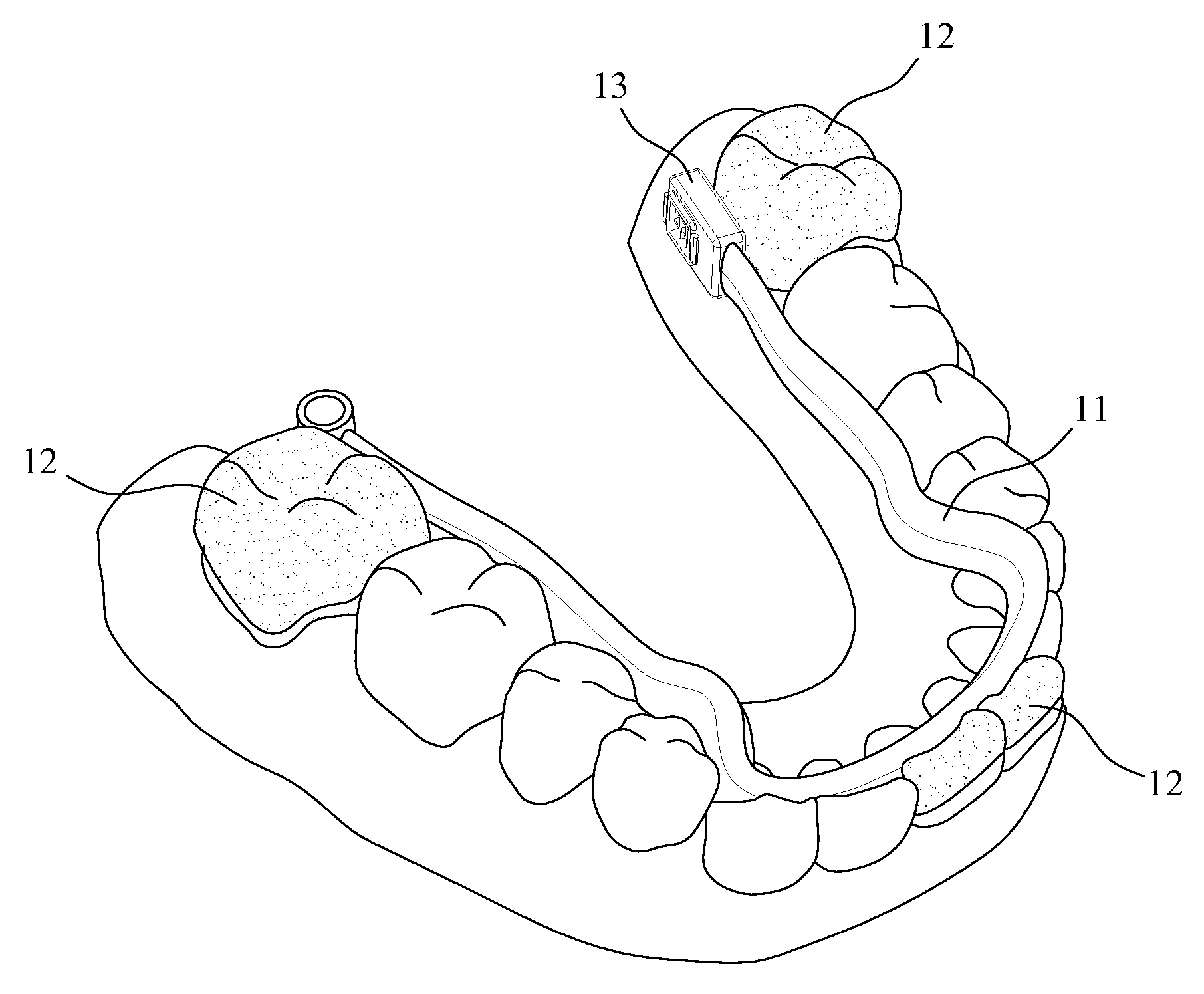 Osmotic orthodontic appliance