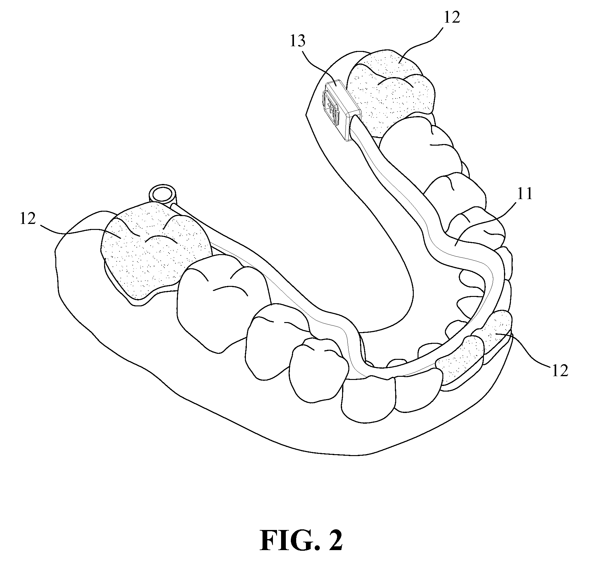 Osmotic orthodontic appliance