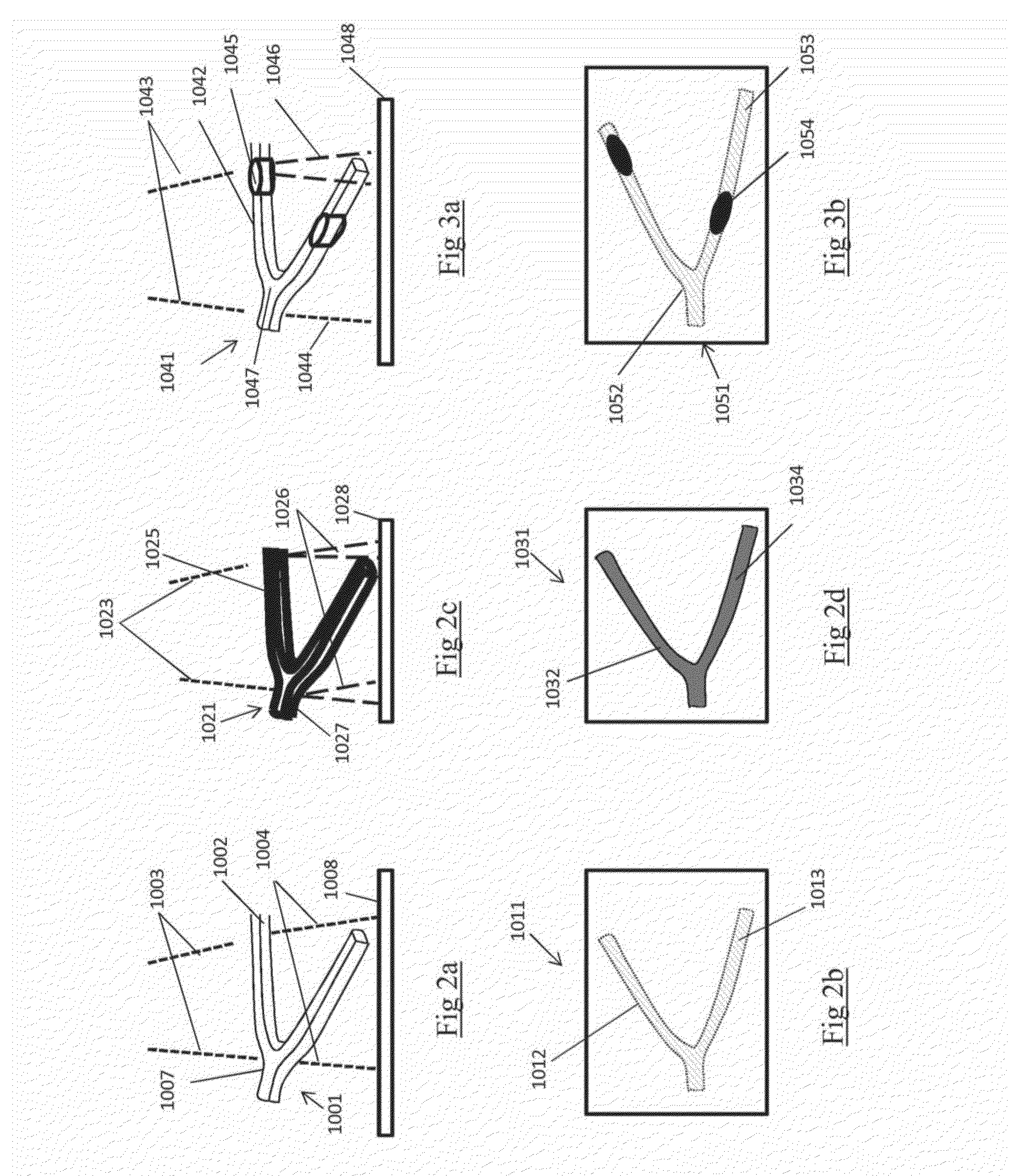 Devices and methods for removal of acute blockages from blood vessels