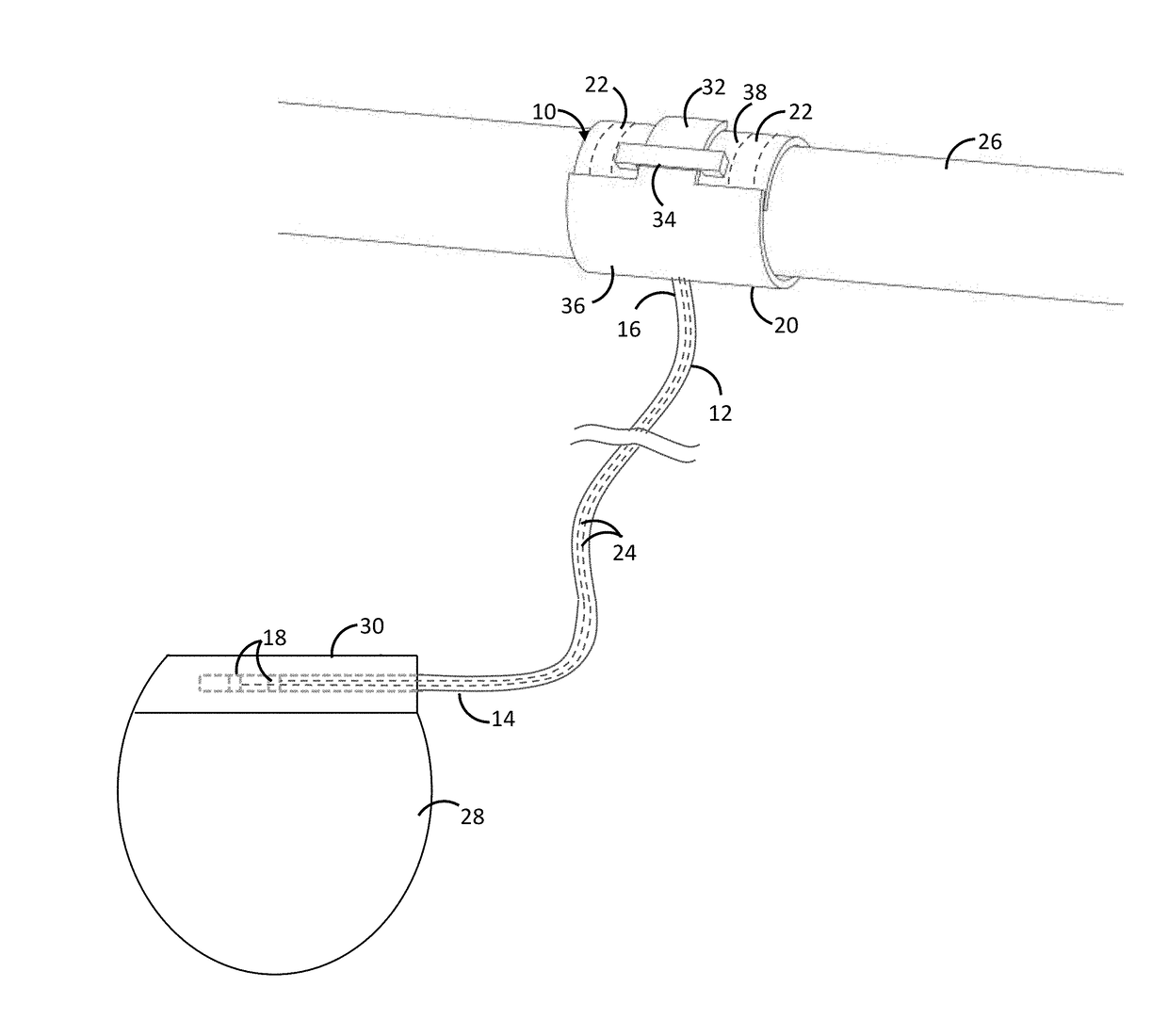 Nerve cuff electrode locking mechanism