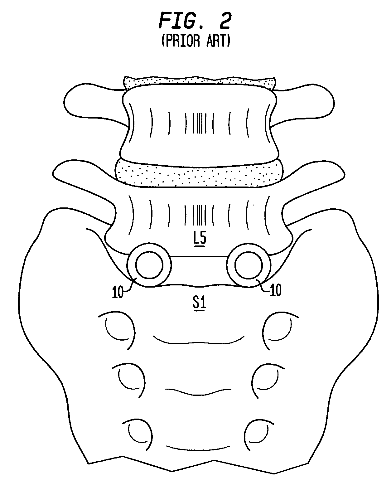 Intervertebral spacer device utilizing a spirally slotted belleville washer having radially extending grooves