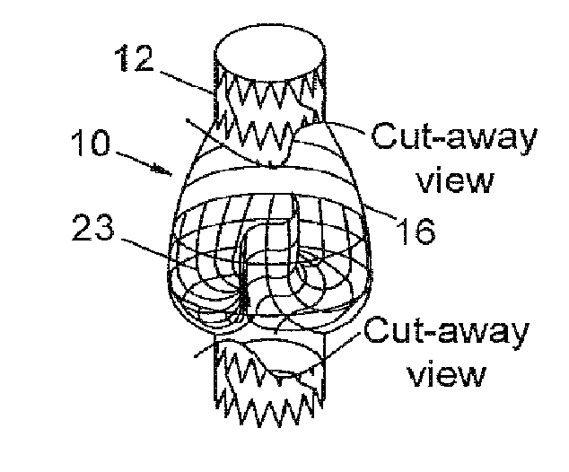 Implantable valve and method