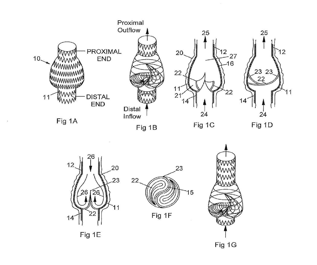 Implantable valve and method