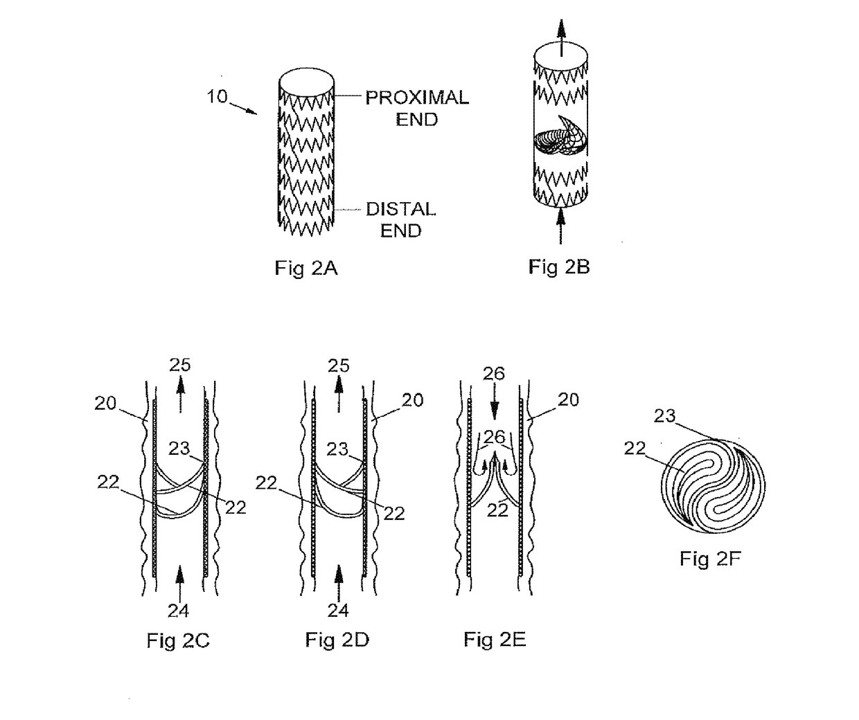 Implantable valve and method