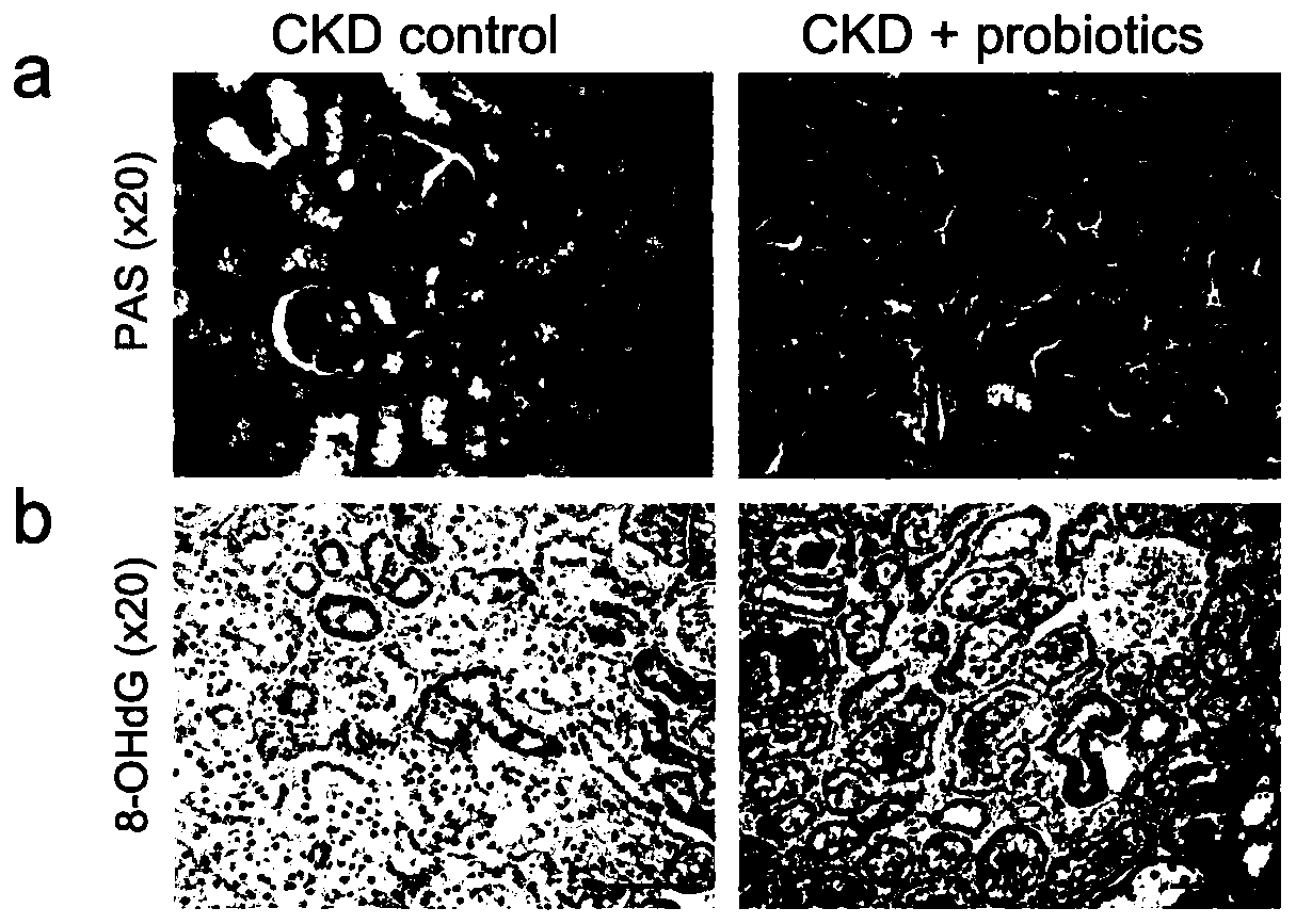 Biomarkers for end-stage renal disease and application thereof