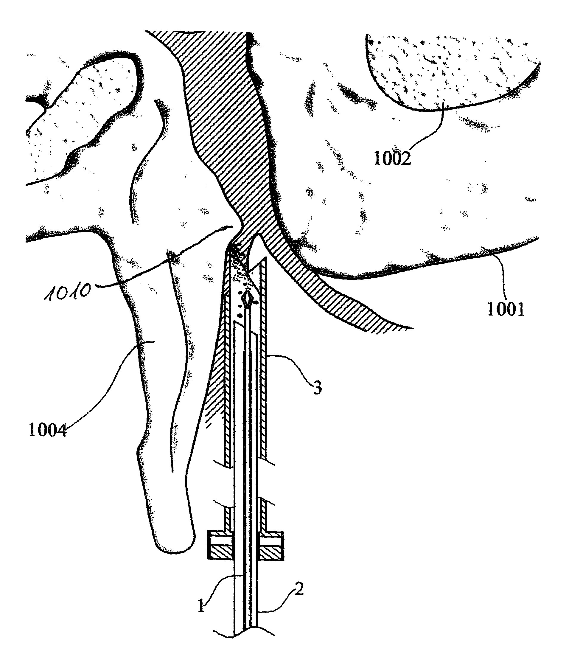 Device and method for minimally invasive spinal intervention