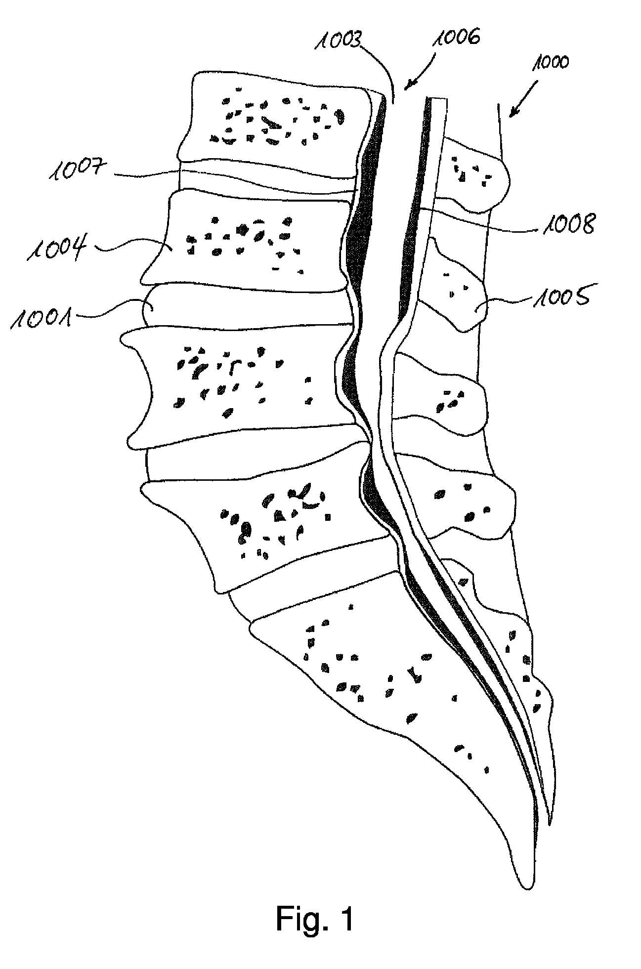 Device and method for minimally invasive spinal intervention