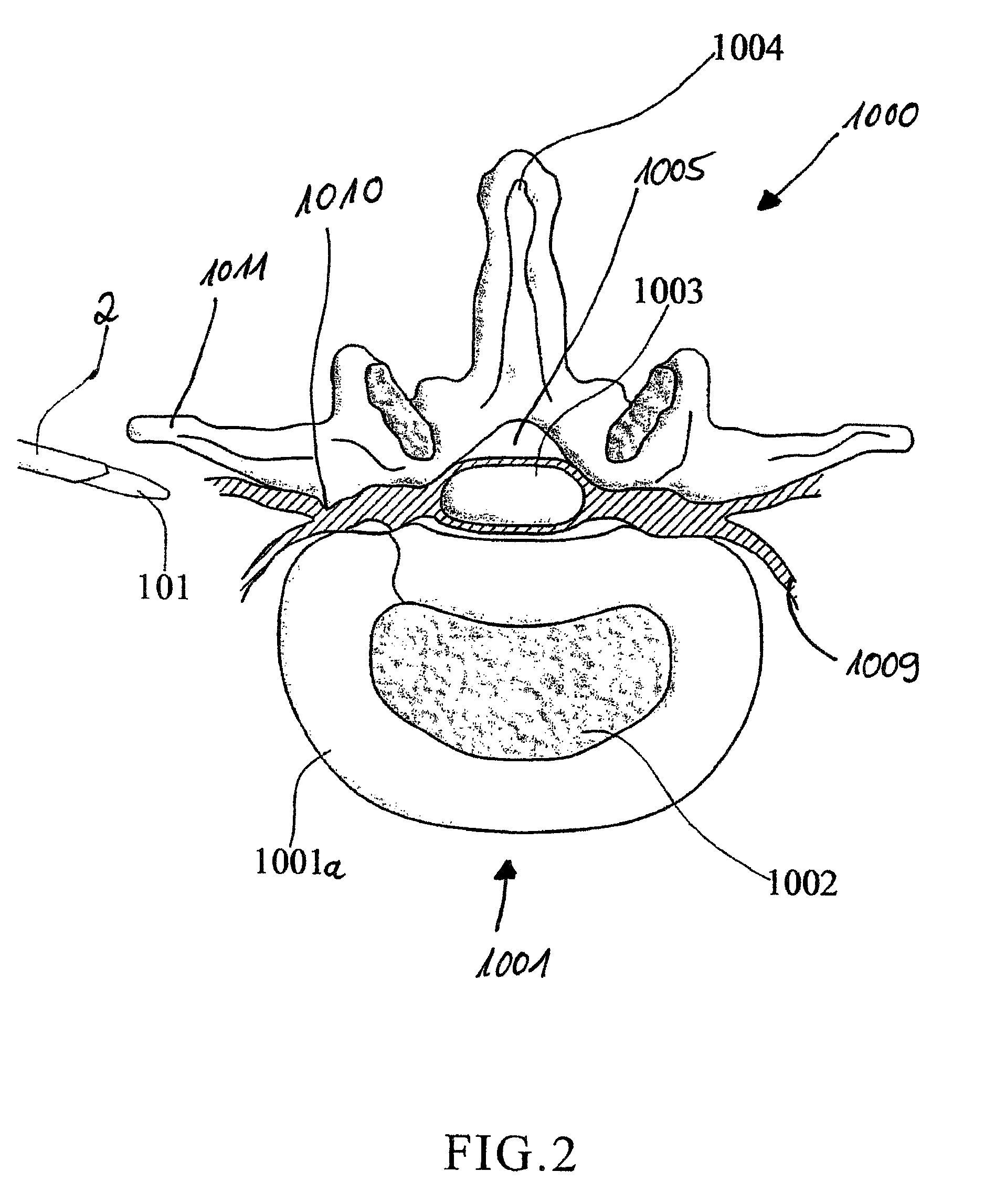 Device and method for minimally invasive spinal intervention