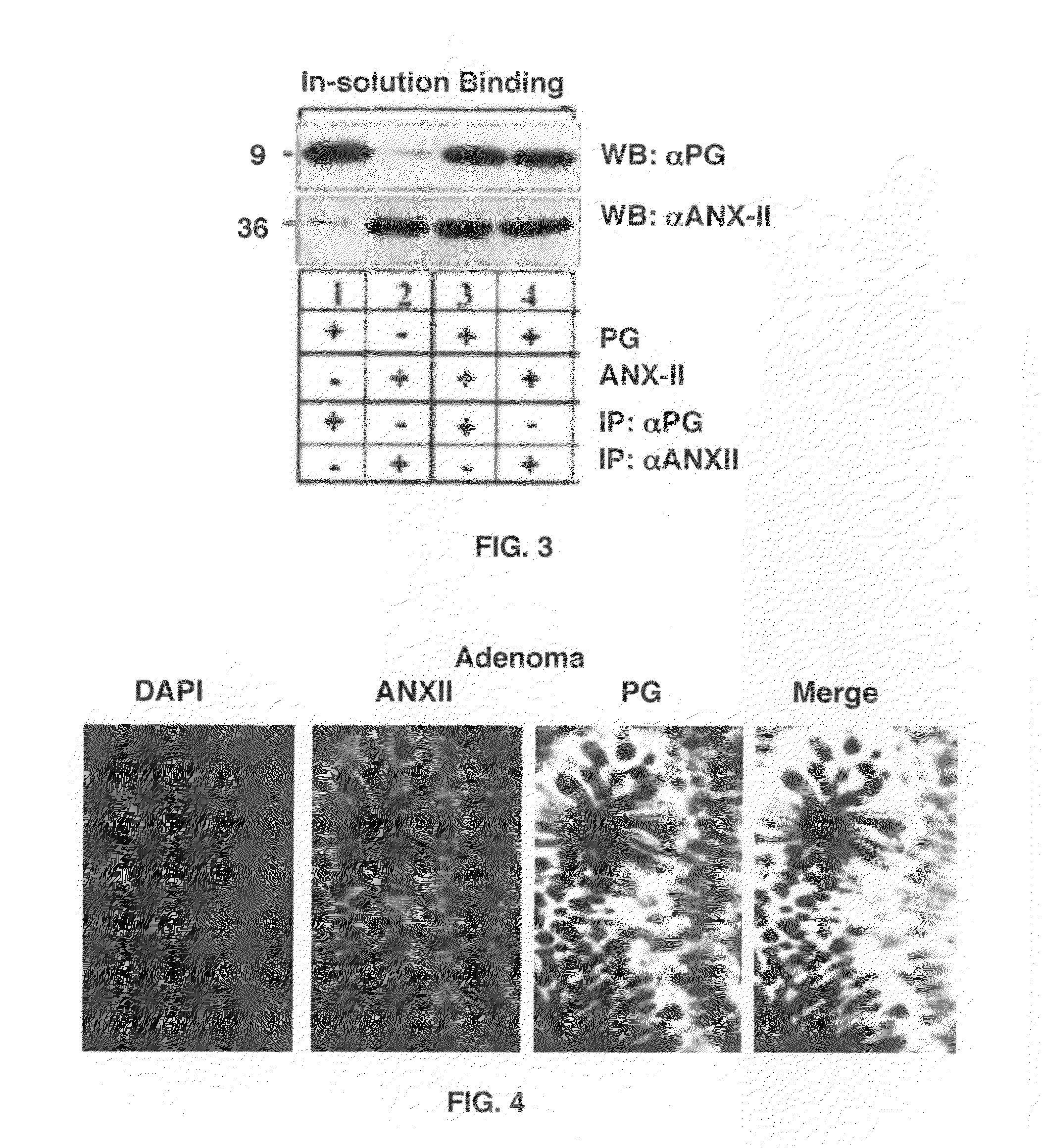 Diagnosis and treatment of epithelial cancers using labeled/conjugated progastrin peptides